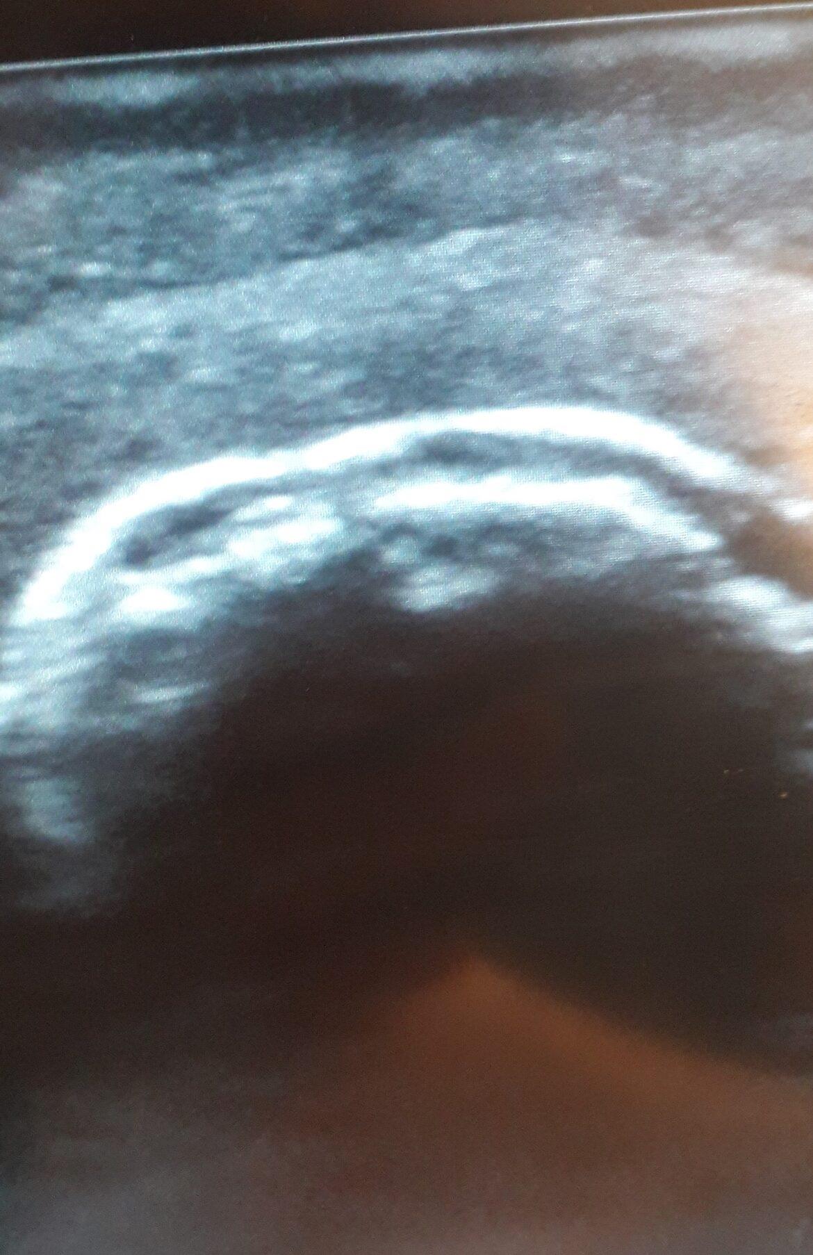 Ultrasound---Exercise-Model-Shoulder-7