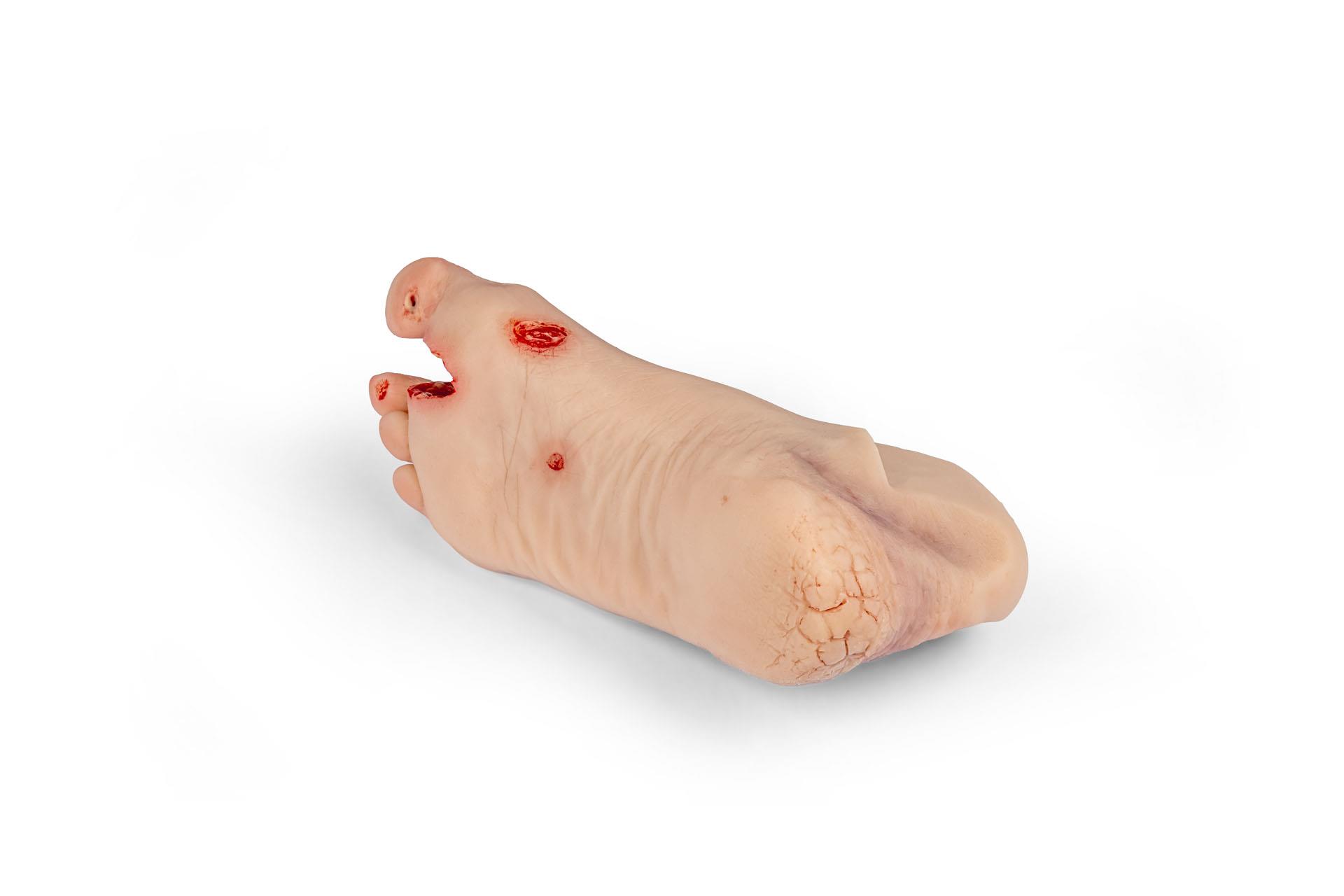 Wundenfuß-mit-diabetischem-Fußsyndrom-fortg-Stadium-für-Nursing-Anne-4