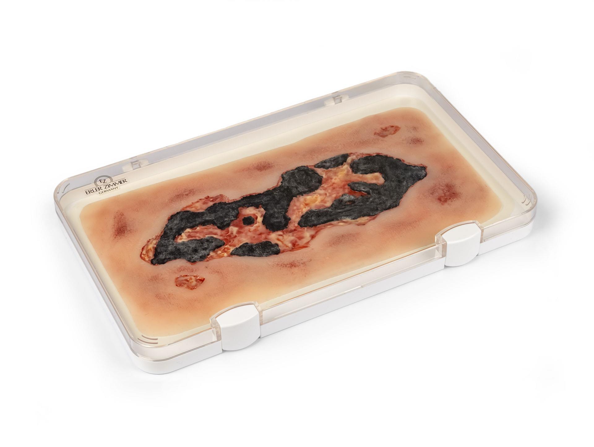 Wundmoulage-Ulcus-Cruris-Arteriosum-groß-Exsudationsphase-1
