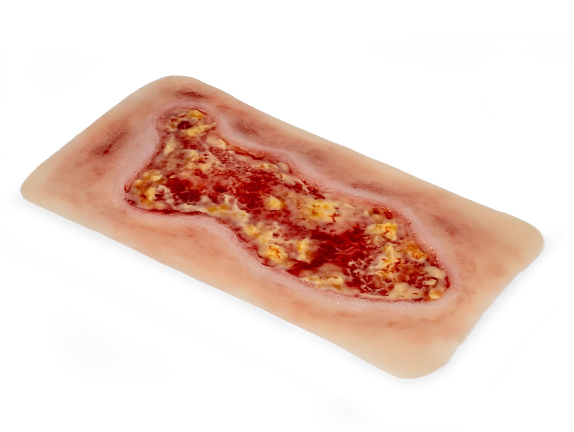 Wound-moulage-venous-leg-ulcer-large-exudation-phase-3