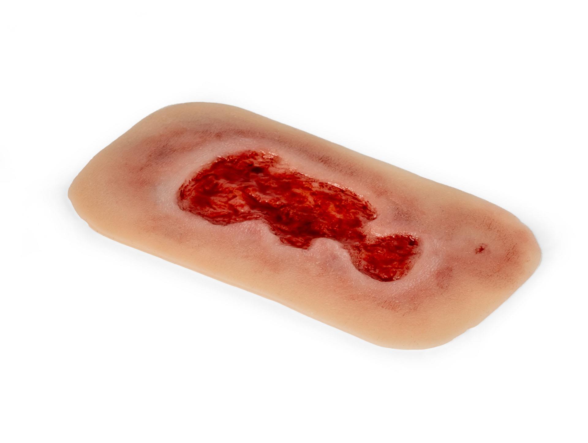 Wound-moulage-venous-leg-ulcer-small-granulation-phase-3