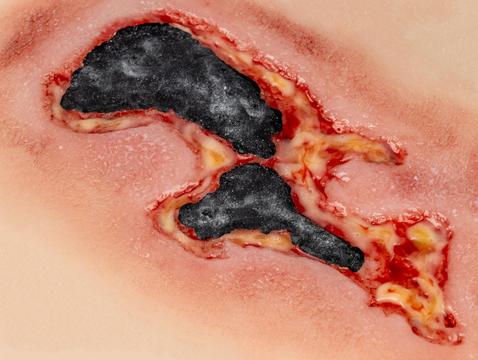 Wound-moulage-arterial-leg-ulcer-small-exudation-phase-4