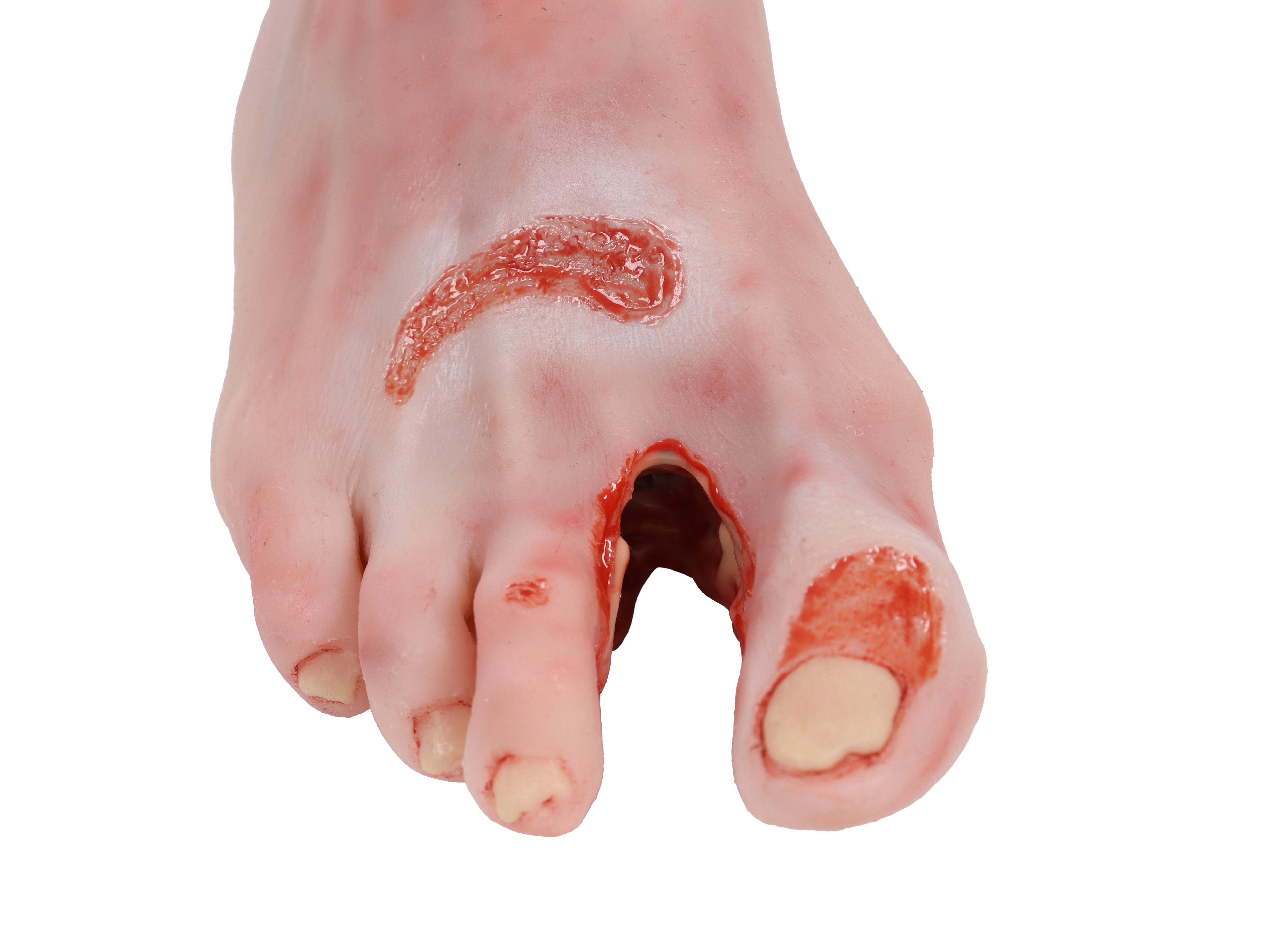 Wound-foot-with-diabetic-foot-syndrome-severe-stage-6