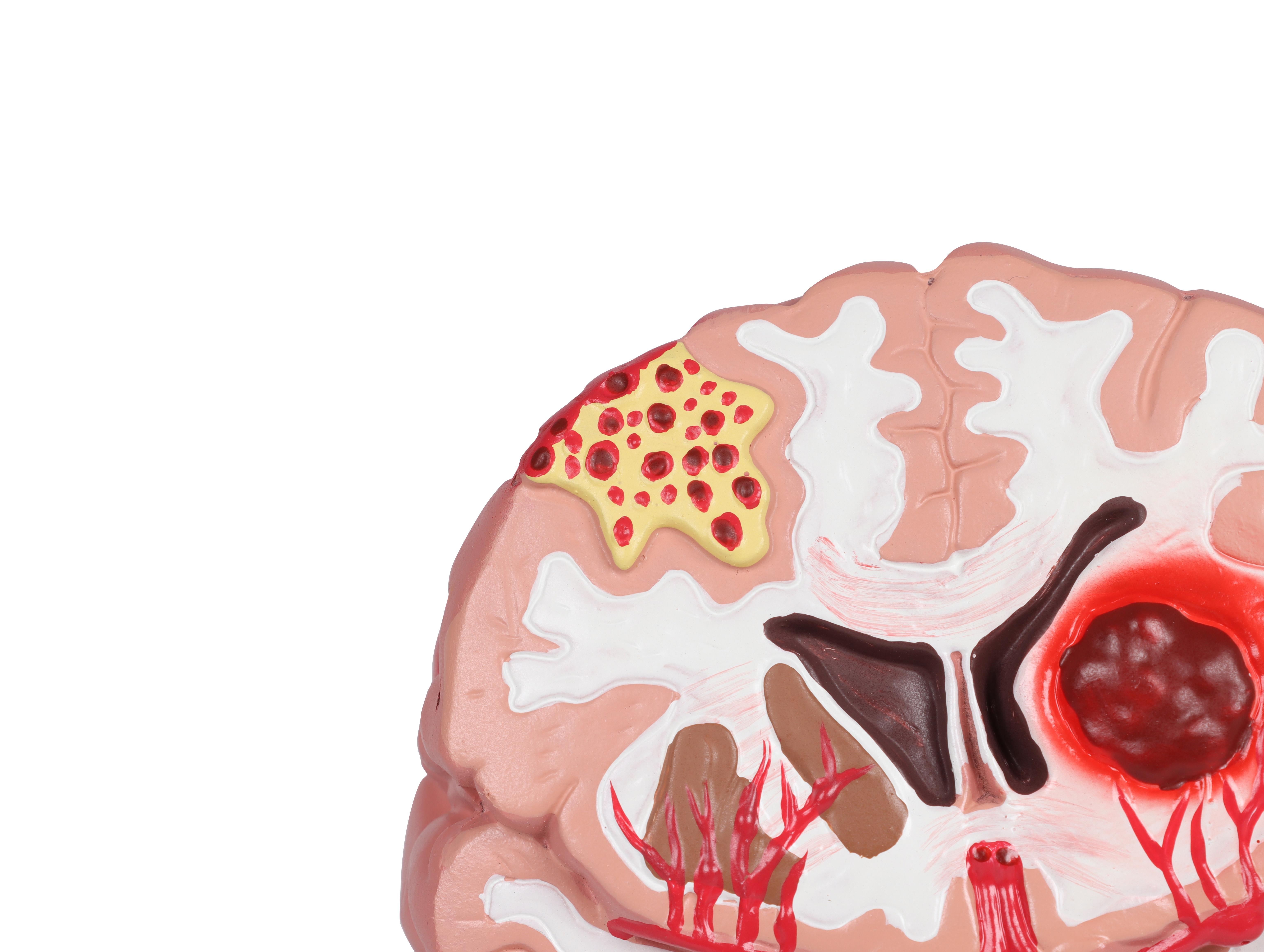 Pathologien-des-Gehirns-lebensgröße-3