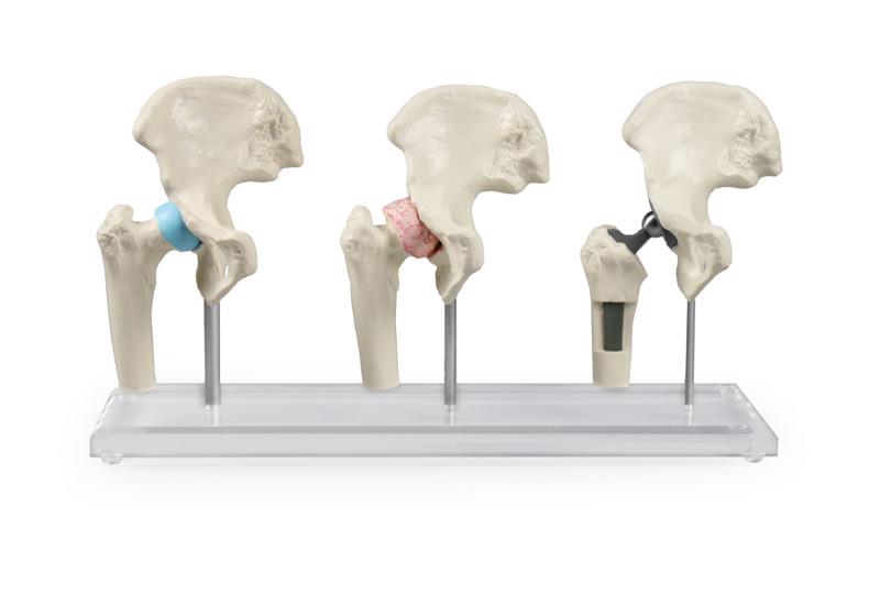 3 modèles du joint de hanche - sain, malade, implant, av. support