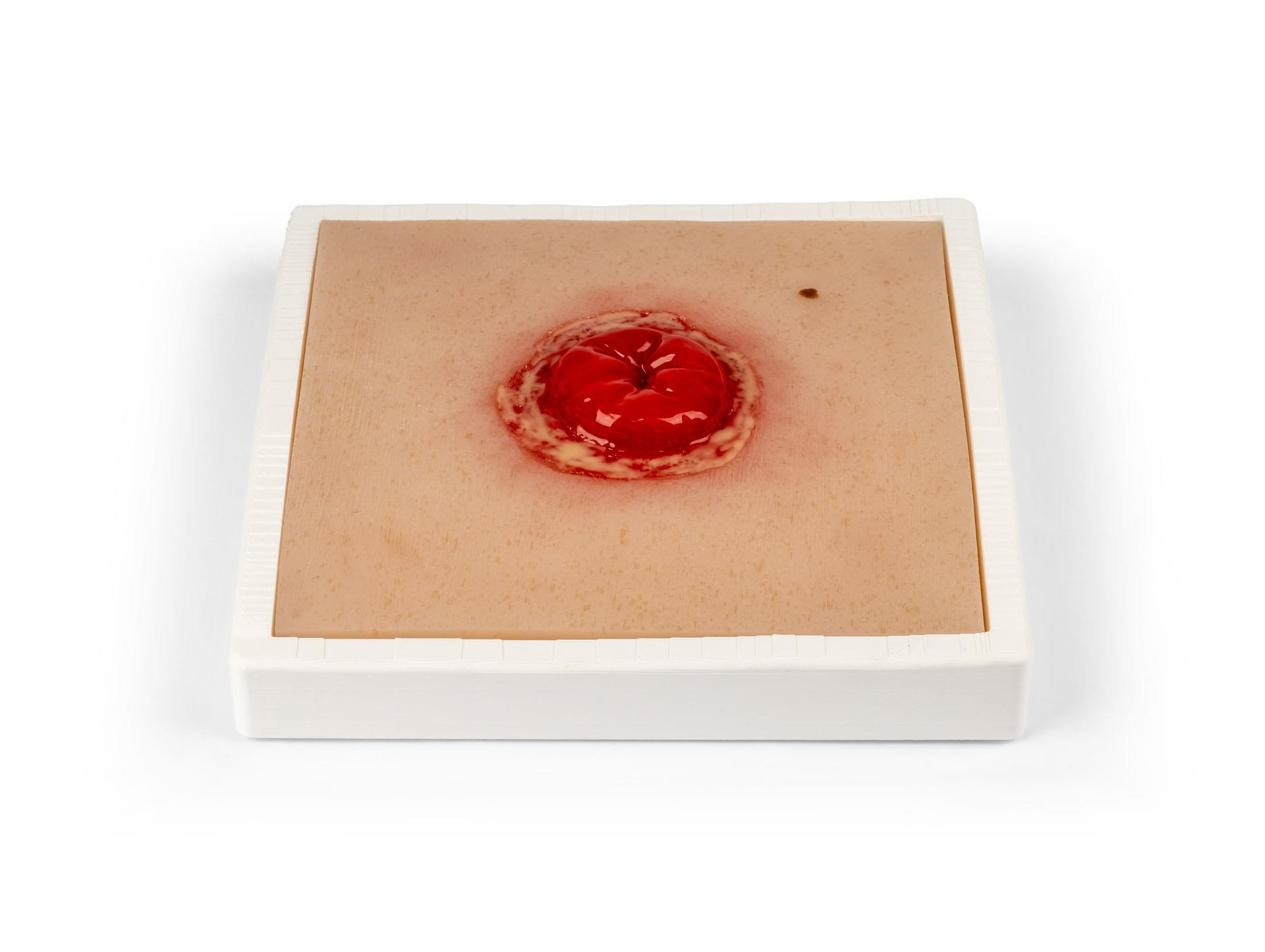Wound-Moulage-Colostoma-with-inflammation-incl-stand-1