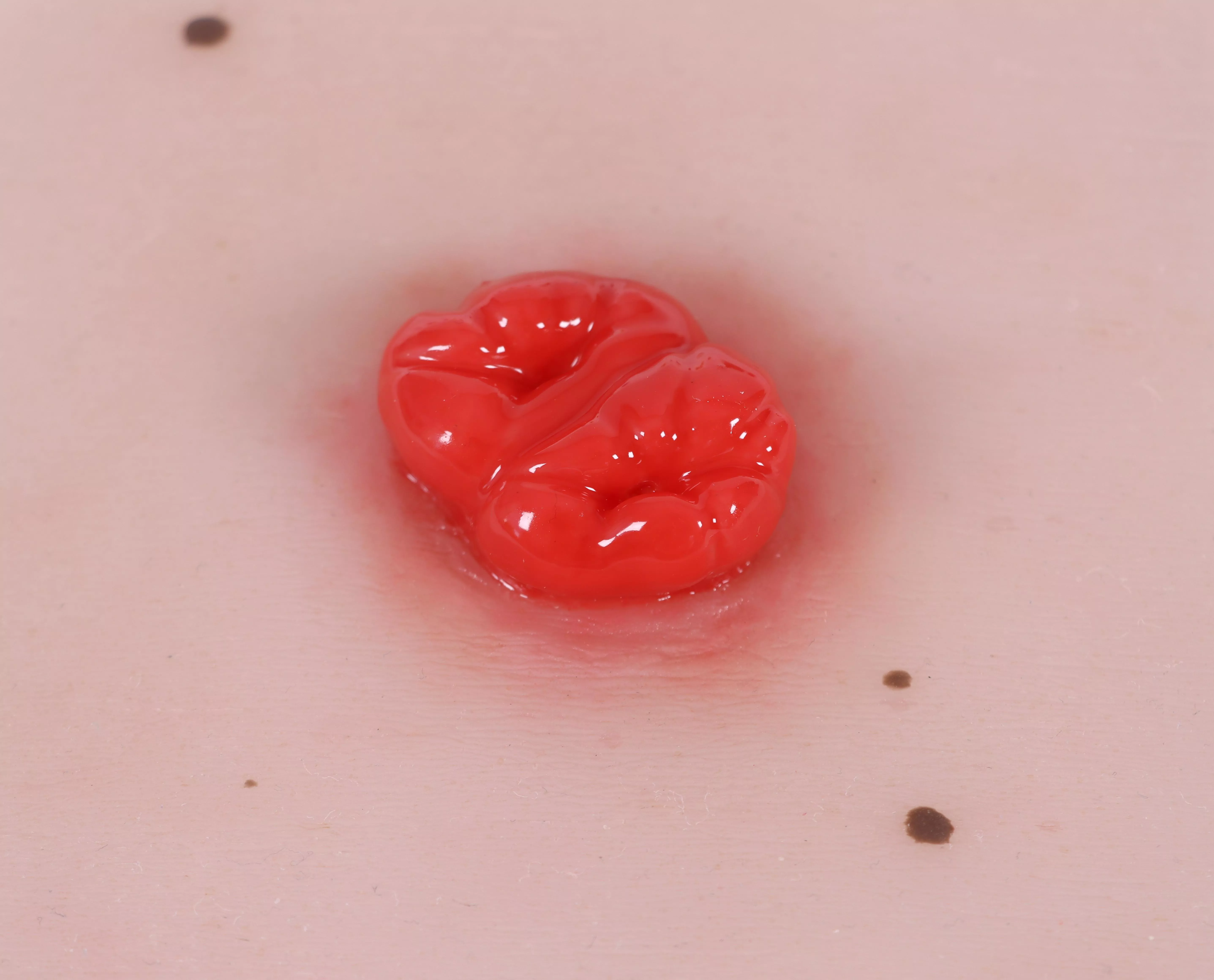 Moulage-de-plaie-colostomie-double,-y-compris-base-2