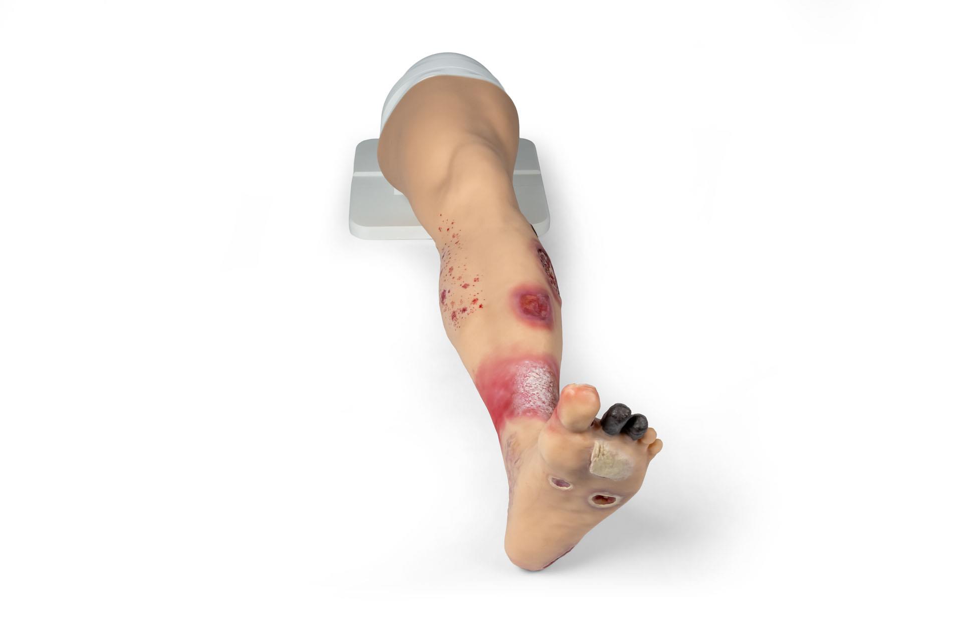 Lena-Leg-Jambe-atteinte-de-maladies-3