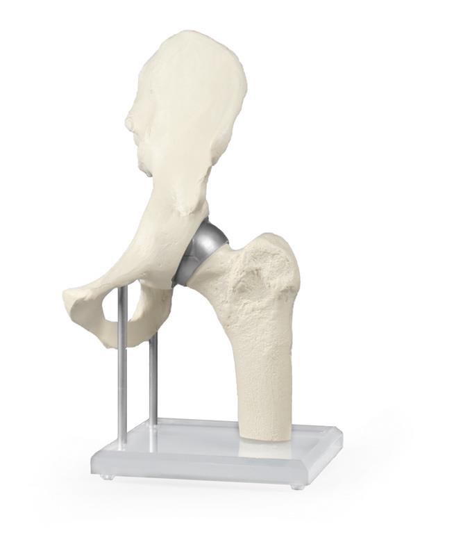 Articulation de la hanche avec prothèse à coque