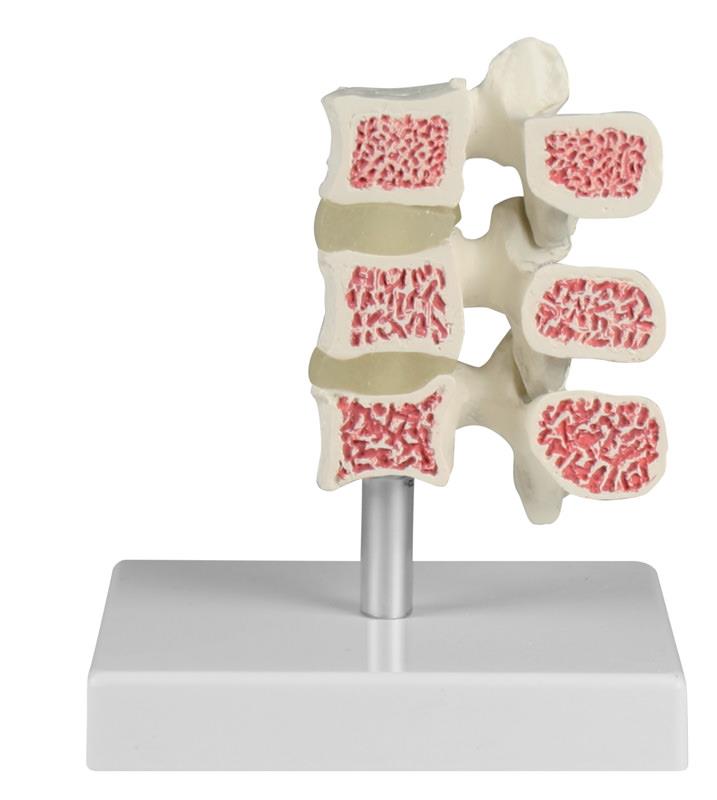 Osteoporosis vertebrae model, 3 vertebrae