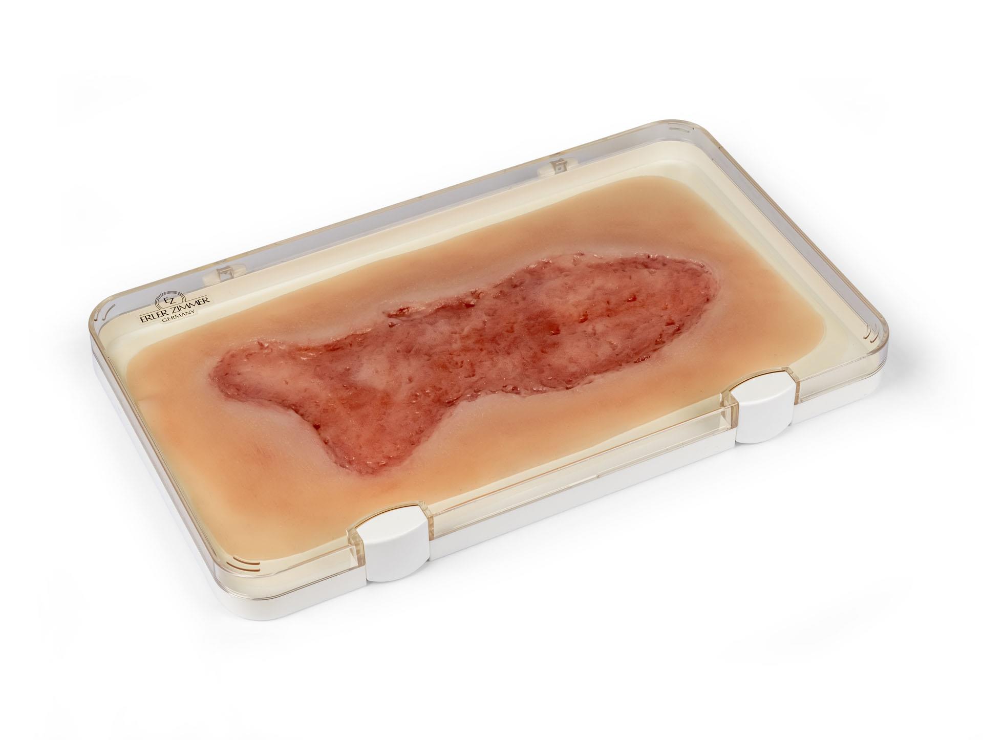 Wound-moulage-venous-leg-ulcer-large-epithelisation phase-1