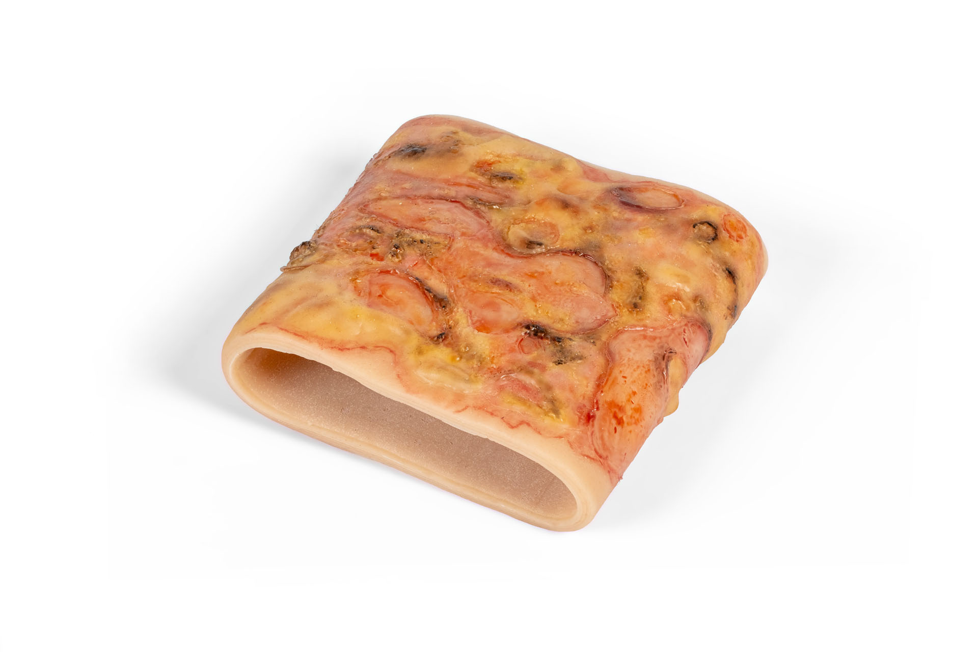 Wound Moulage Sleeve for Second-Degree Burns, Upper Arm