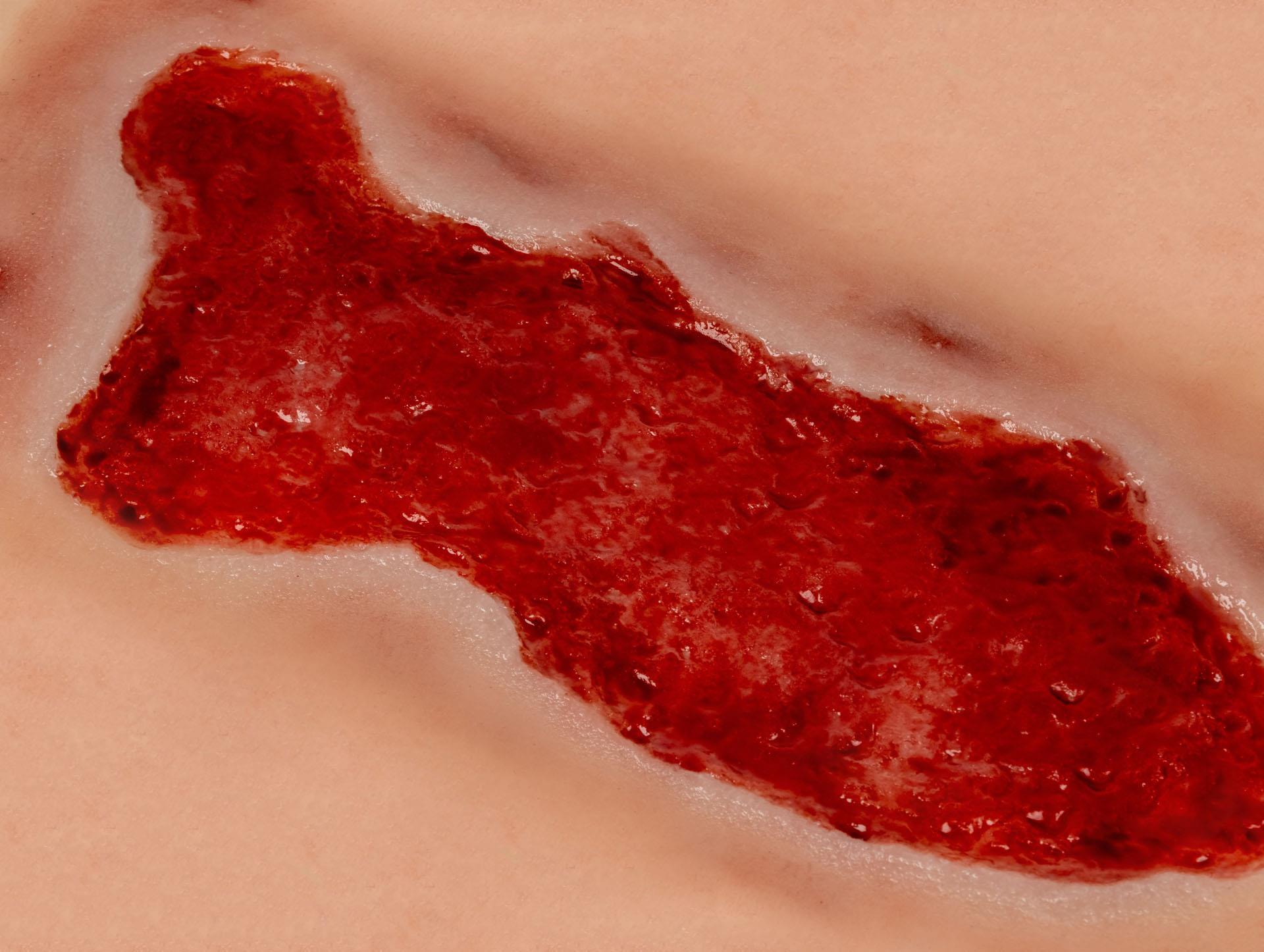 Wundmoulage-Ulcus-Cruris-Venosum-groß-Granulationsphase-4