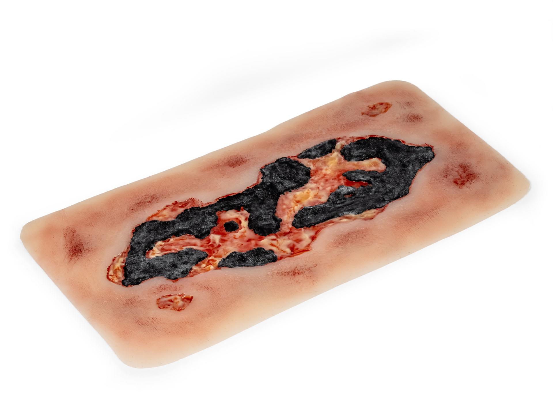 Wundmoulage-Ulcus-Cruris-Arteriosum-groß-Exsudationsphase-2
