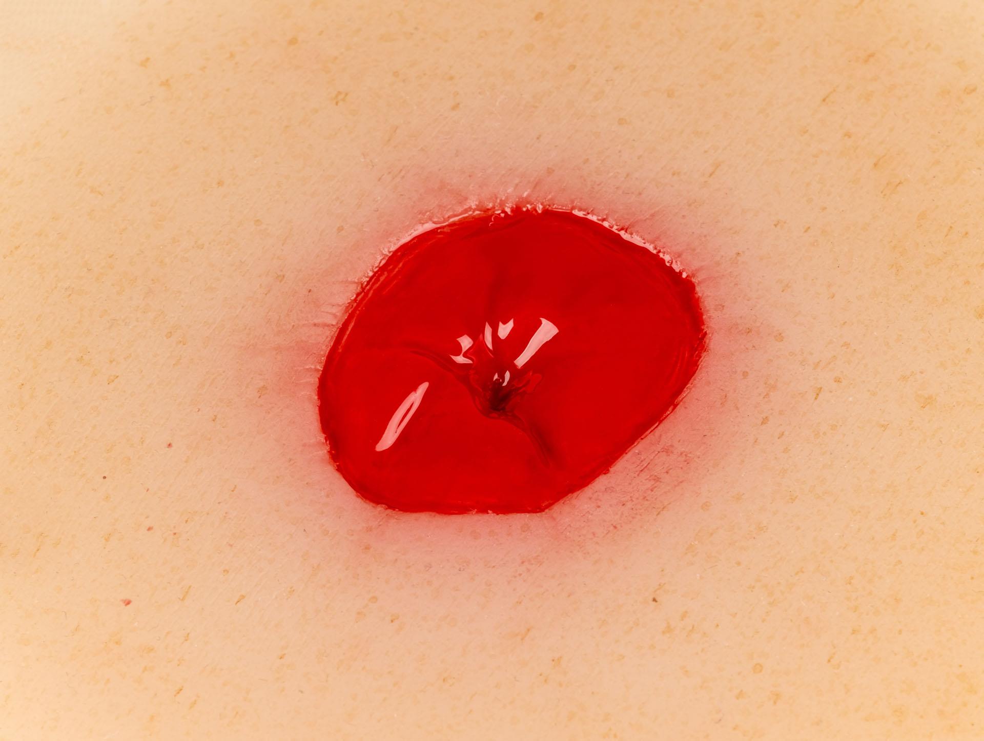 Wundmoulage-Kolostoma-unter-Hautniveau-selbsthaftend-1