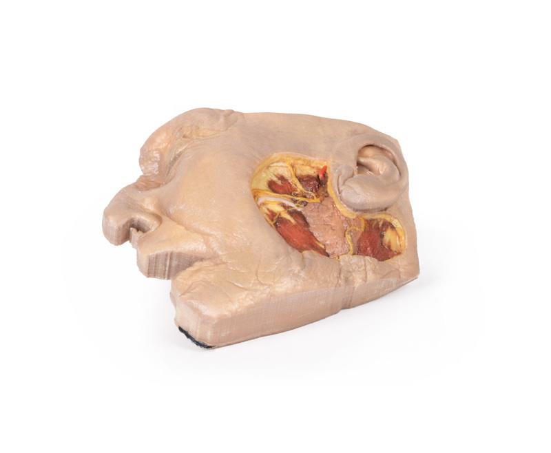 Parotid Gland and Facial Nerve dissection