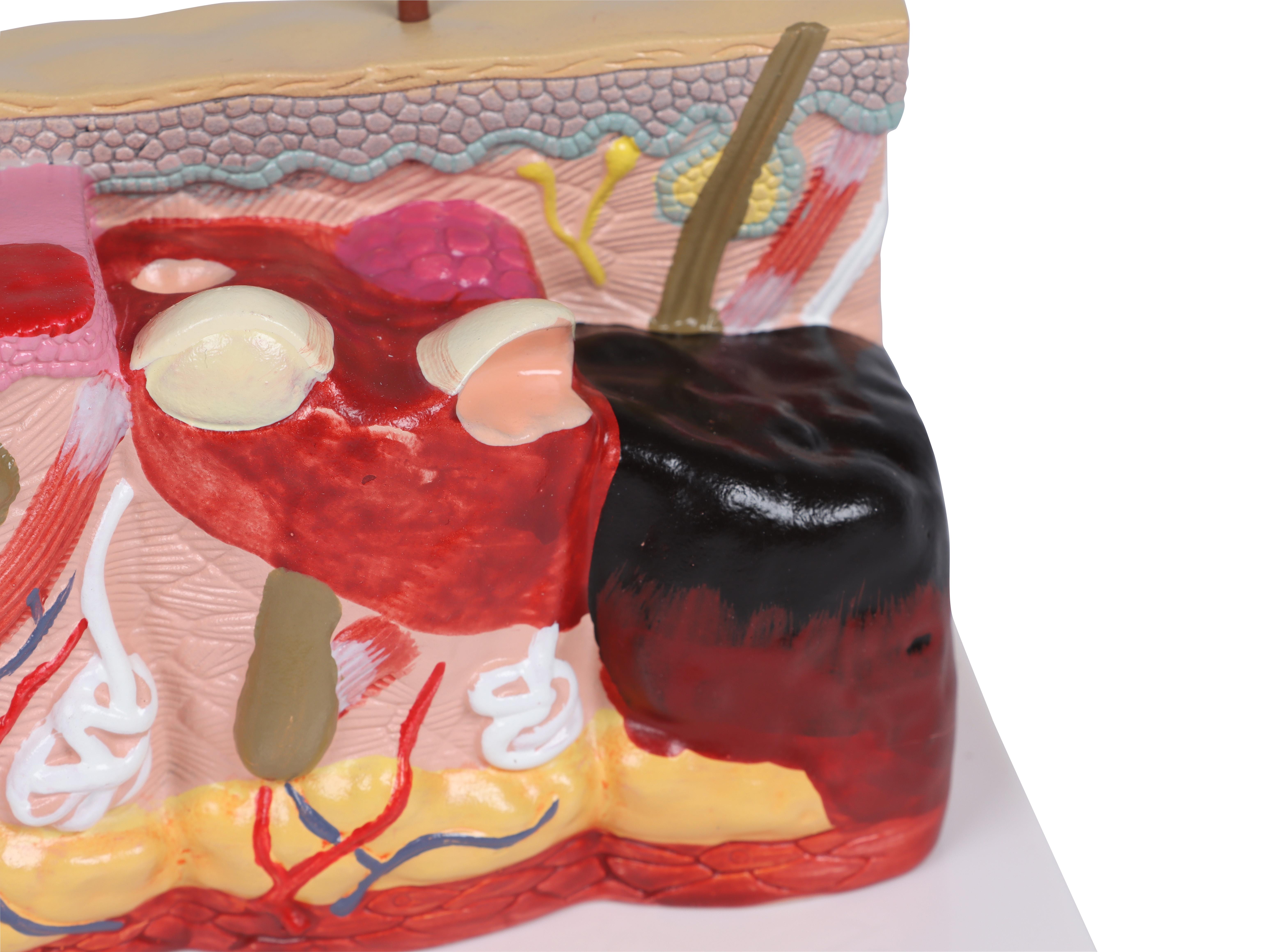 Pathologisches-Hautmodell-mit-Verbrennung-30-fache-Größe-4