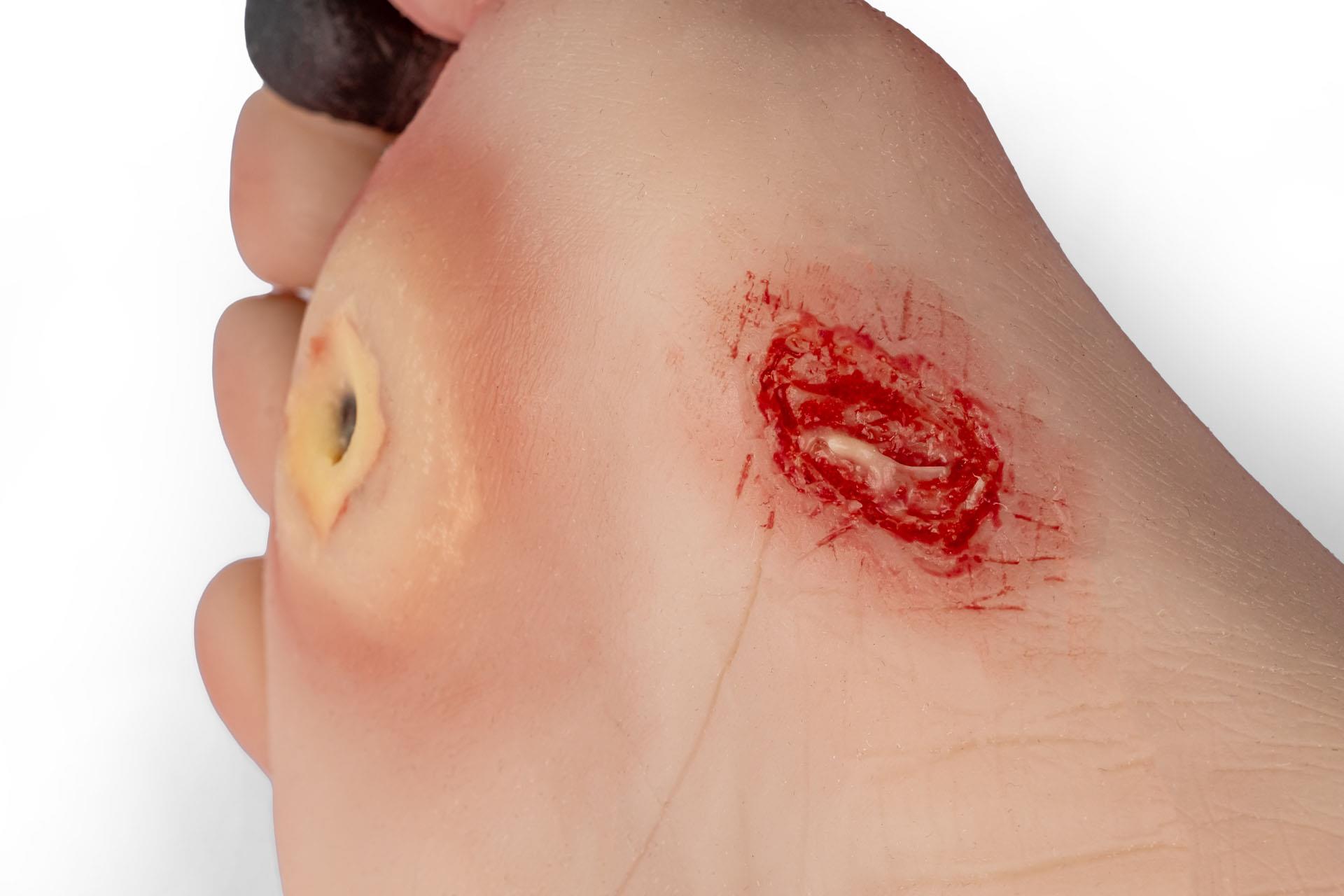 Wound-foot-with-diabetic-foot-syndrome-6