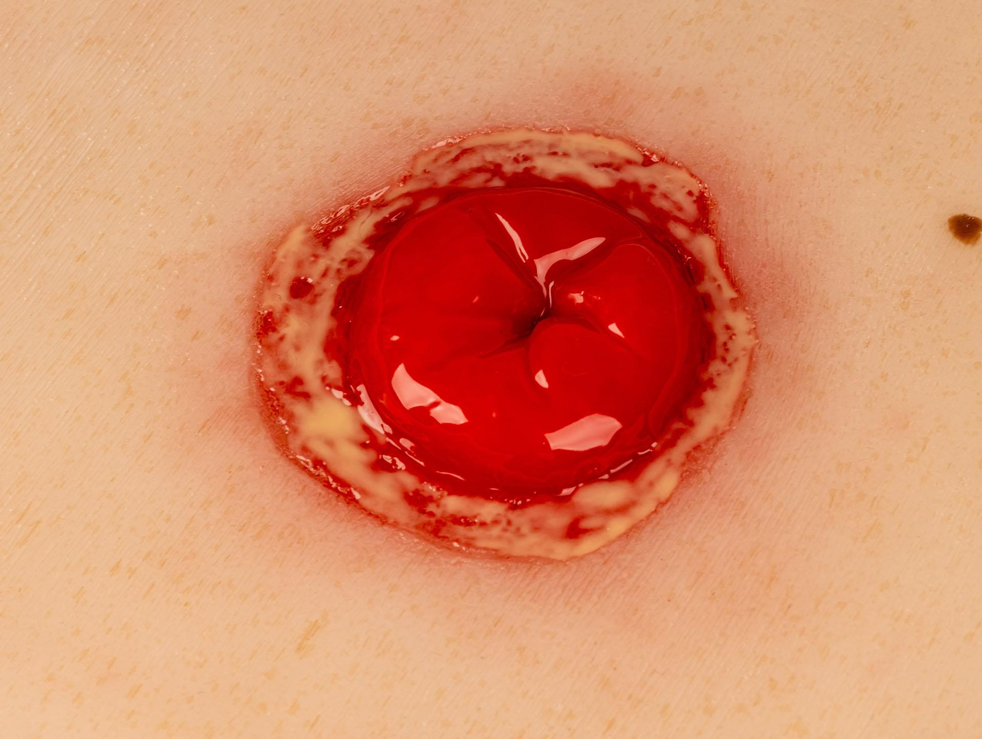 Wound-Moulage-Colostoma-with-inflammation-incl-stand-2