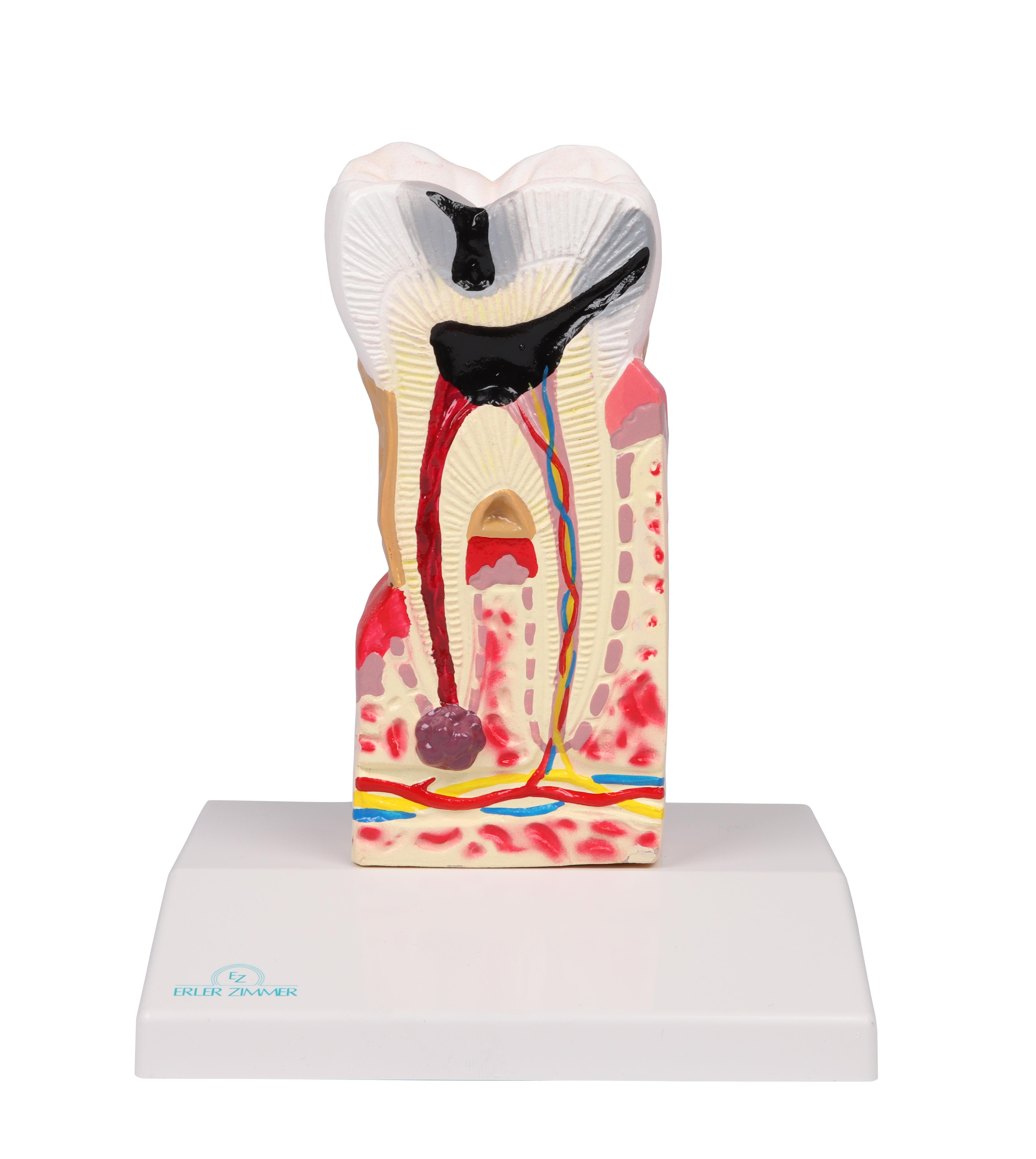 Dental caries model, 10 times life size