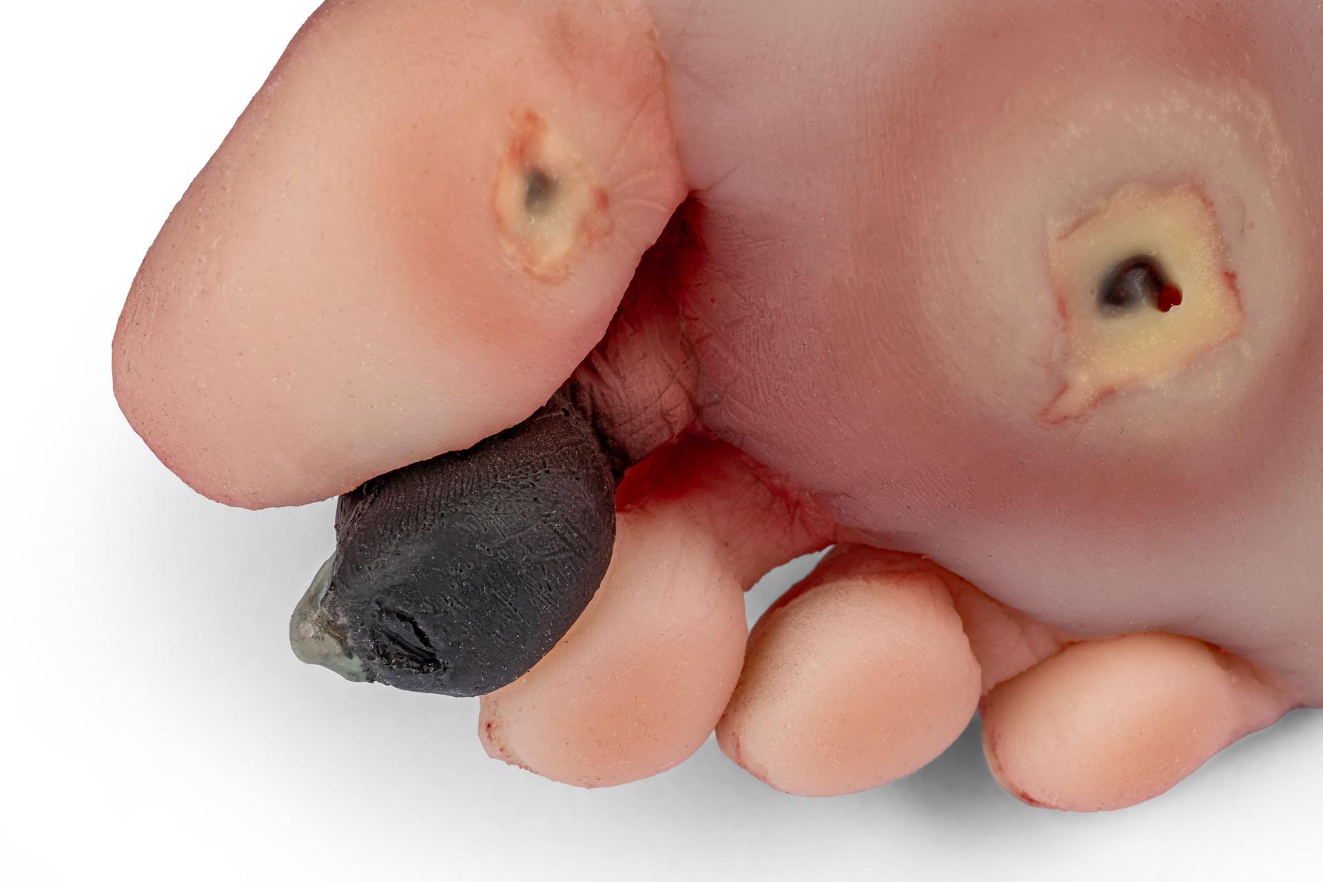 Wound-foot-with-diabetic-foot-syndrome-7
