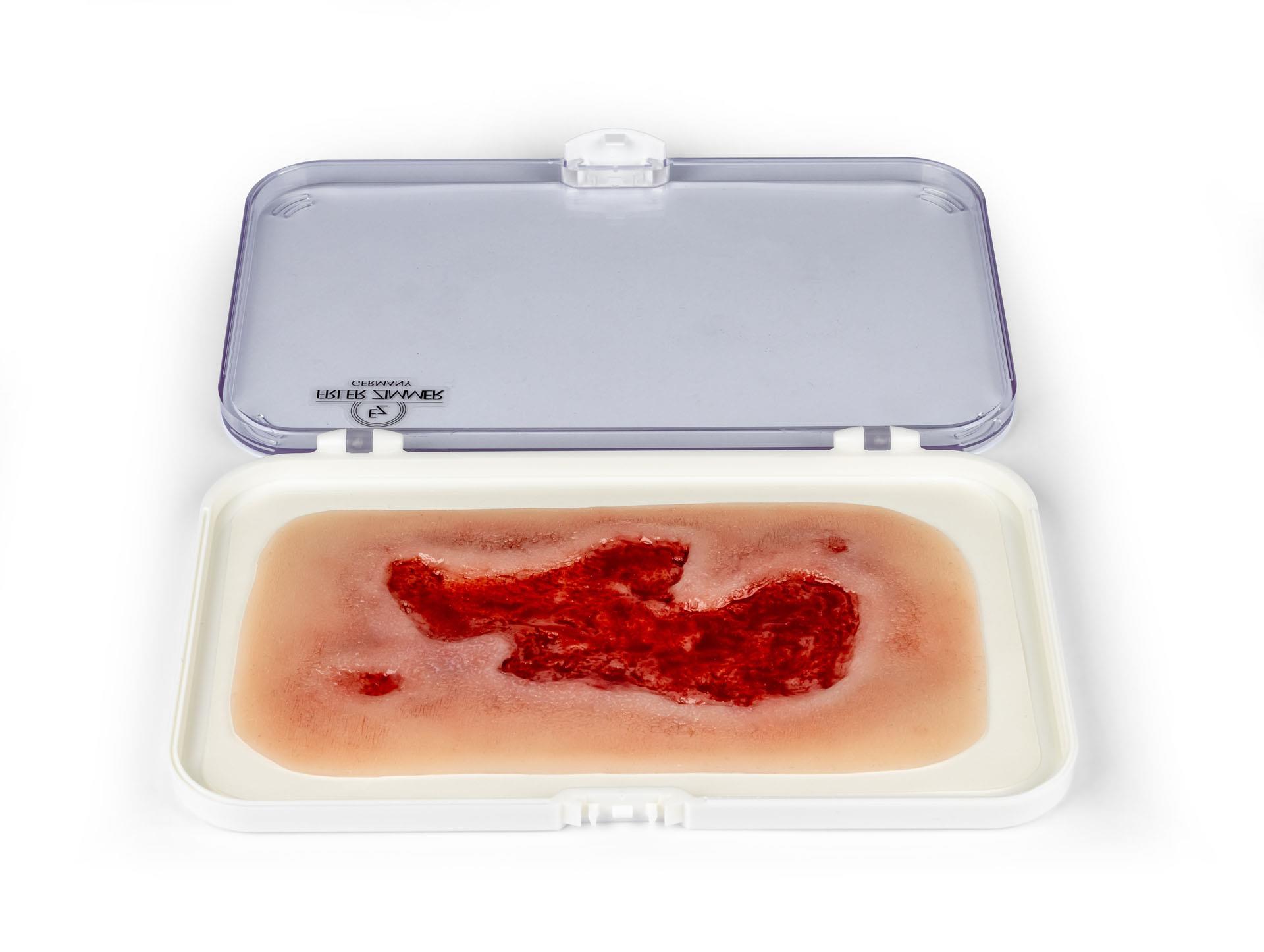 Wundmoulage-Ulcus-Cruris-Arteriosum-klein-Granulationsphase