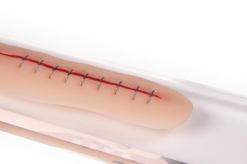 Surgical wound with staples, 22cm