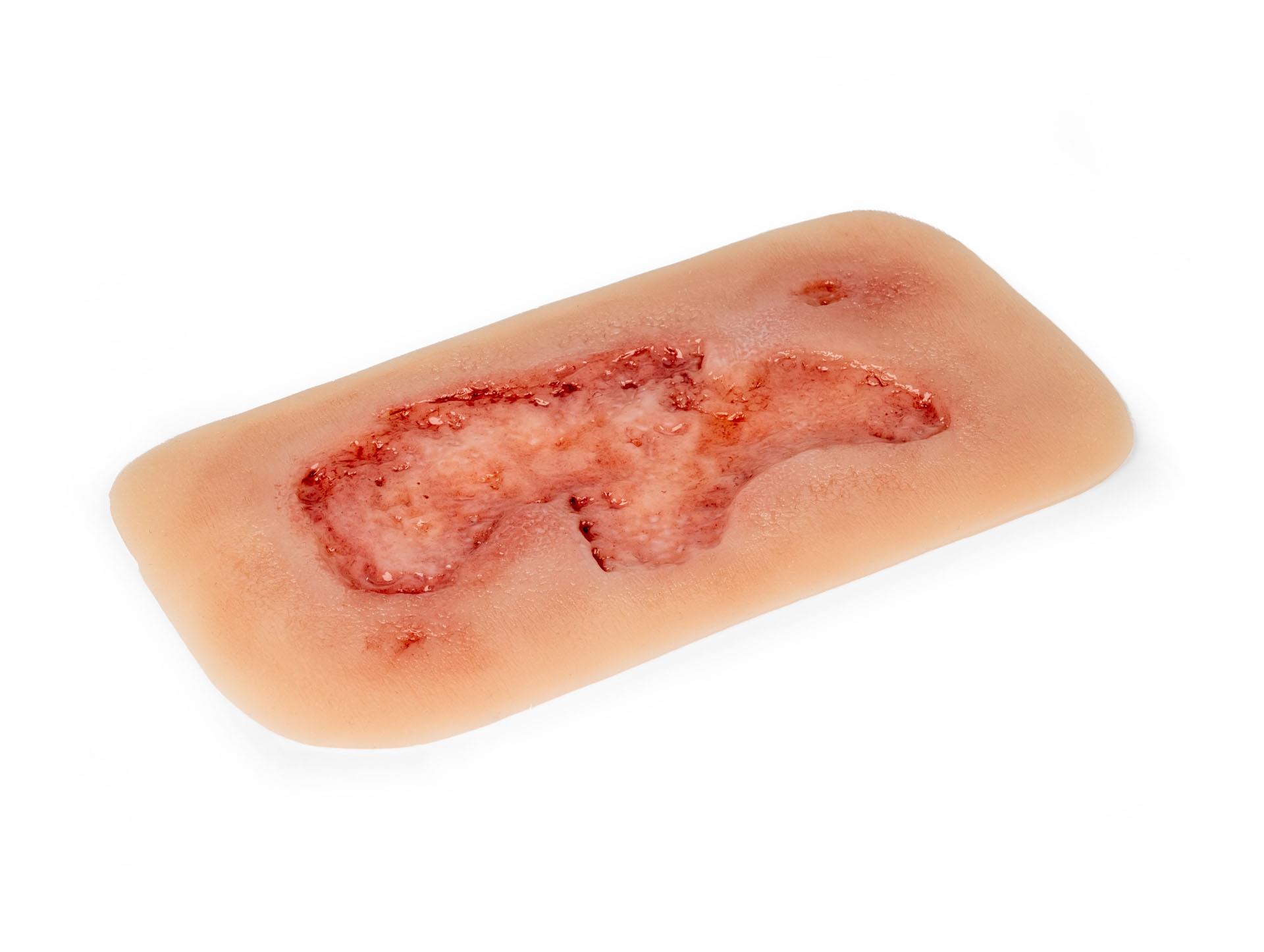 Wound-moulage-arterial-leg-ulcer-small-epithelization-phase-2
