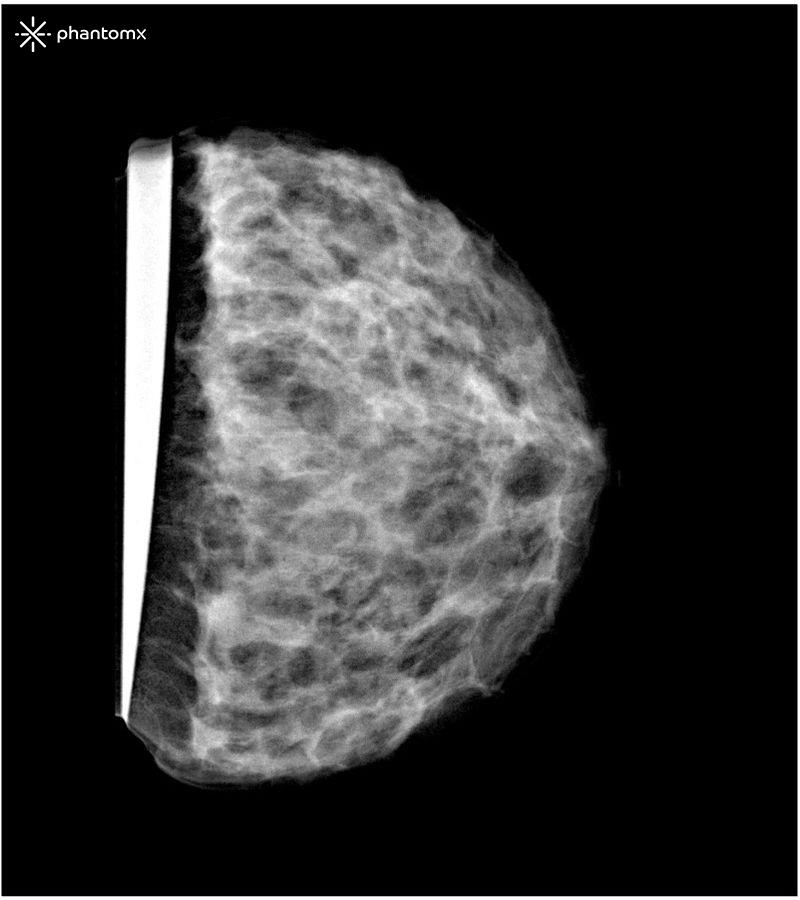Brustphantom-für-Mammographie-und-Brusttomosynthese-1