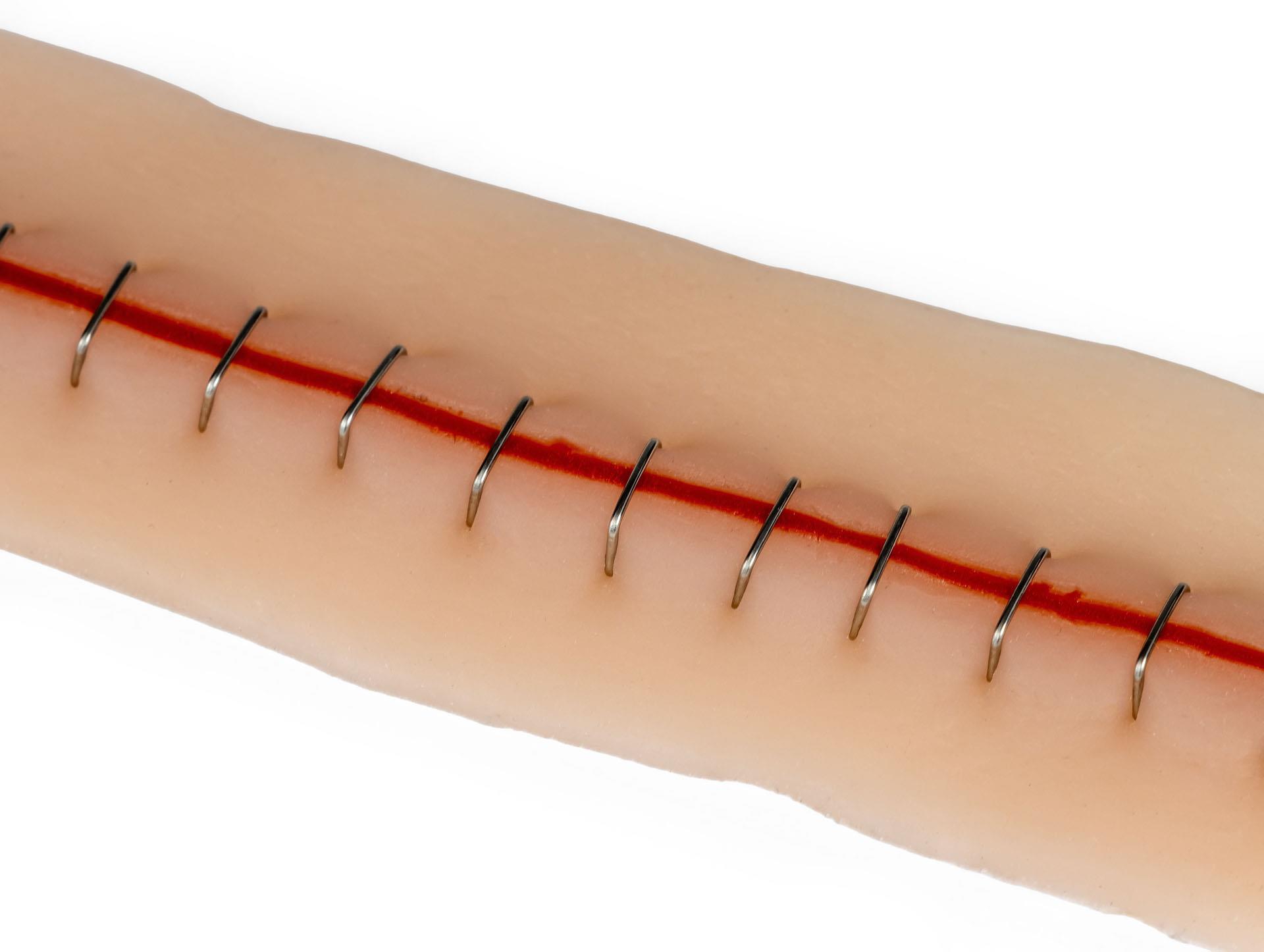 Surgical-wound-with-staples-22cm-1