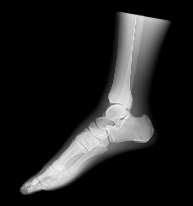 Röntgen-Teilphantom mit künstlichen Knochen - Linker Fuß, transparent