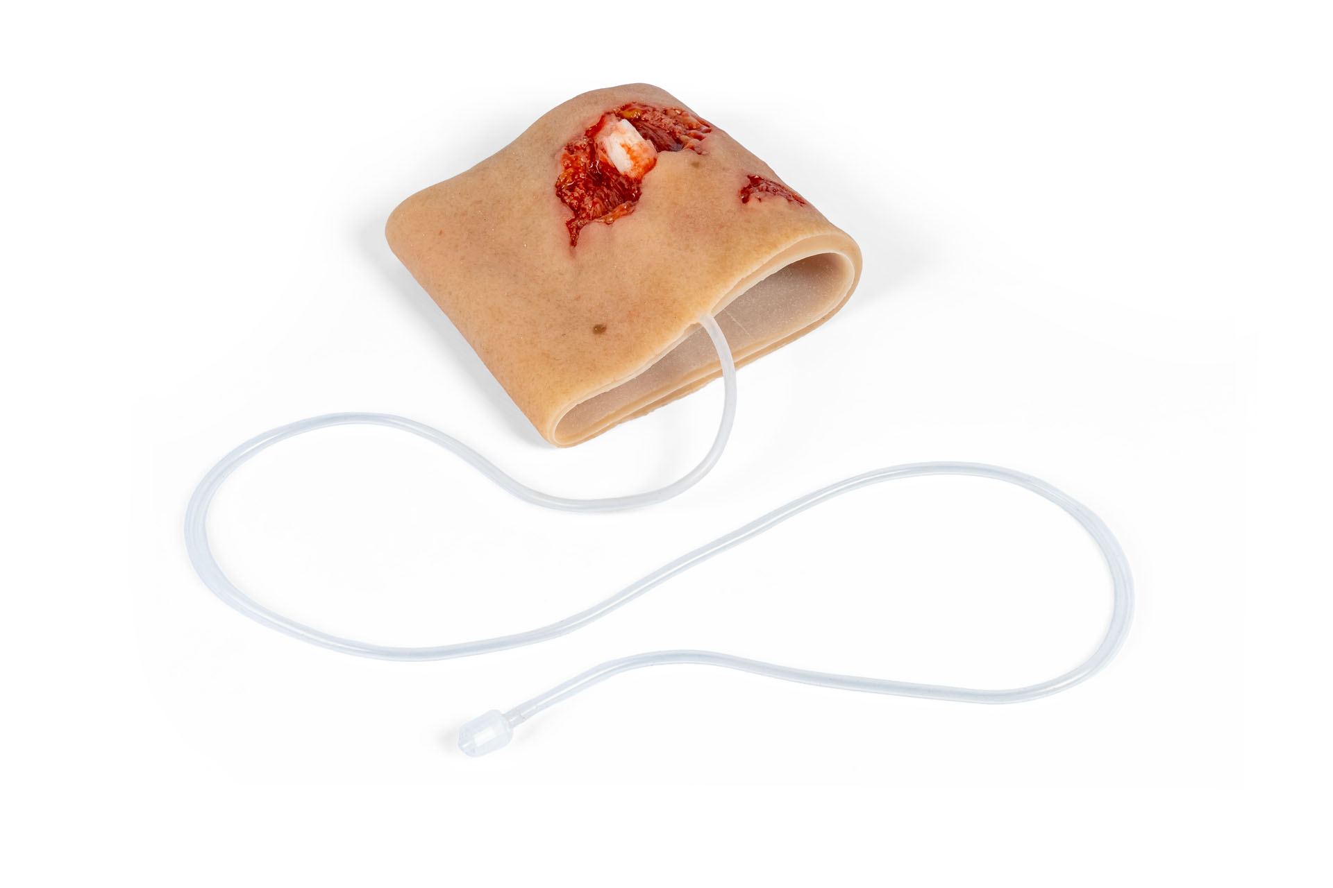 Wound Moulage Sleeve for Open Upper Arm Fracture, with Bleeding Feature