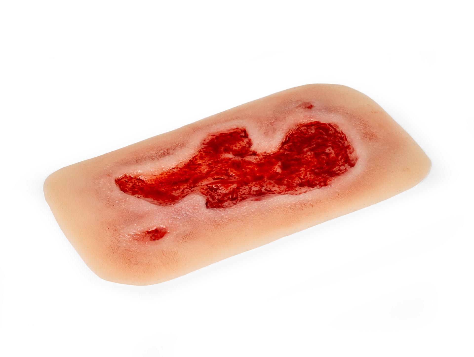 Wundmoulage-Ulcus-Cruris-Arteriosum-klein-Granulationsphase-2