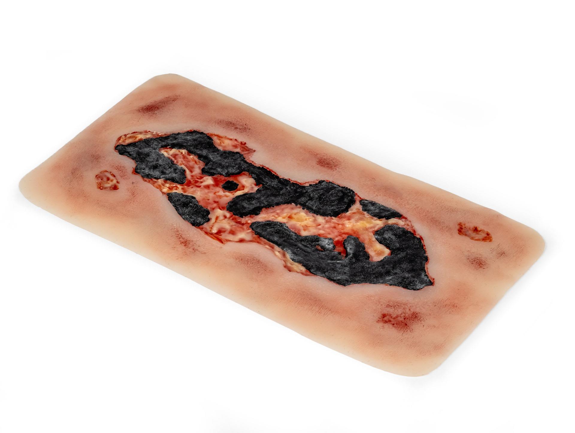 Wundmoulage-Ulcus-Cruris-Arteriosum-groß-Exsudationsphase-3