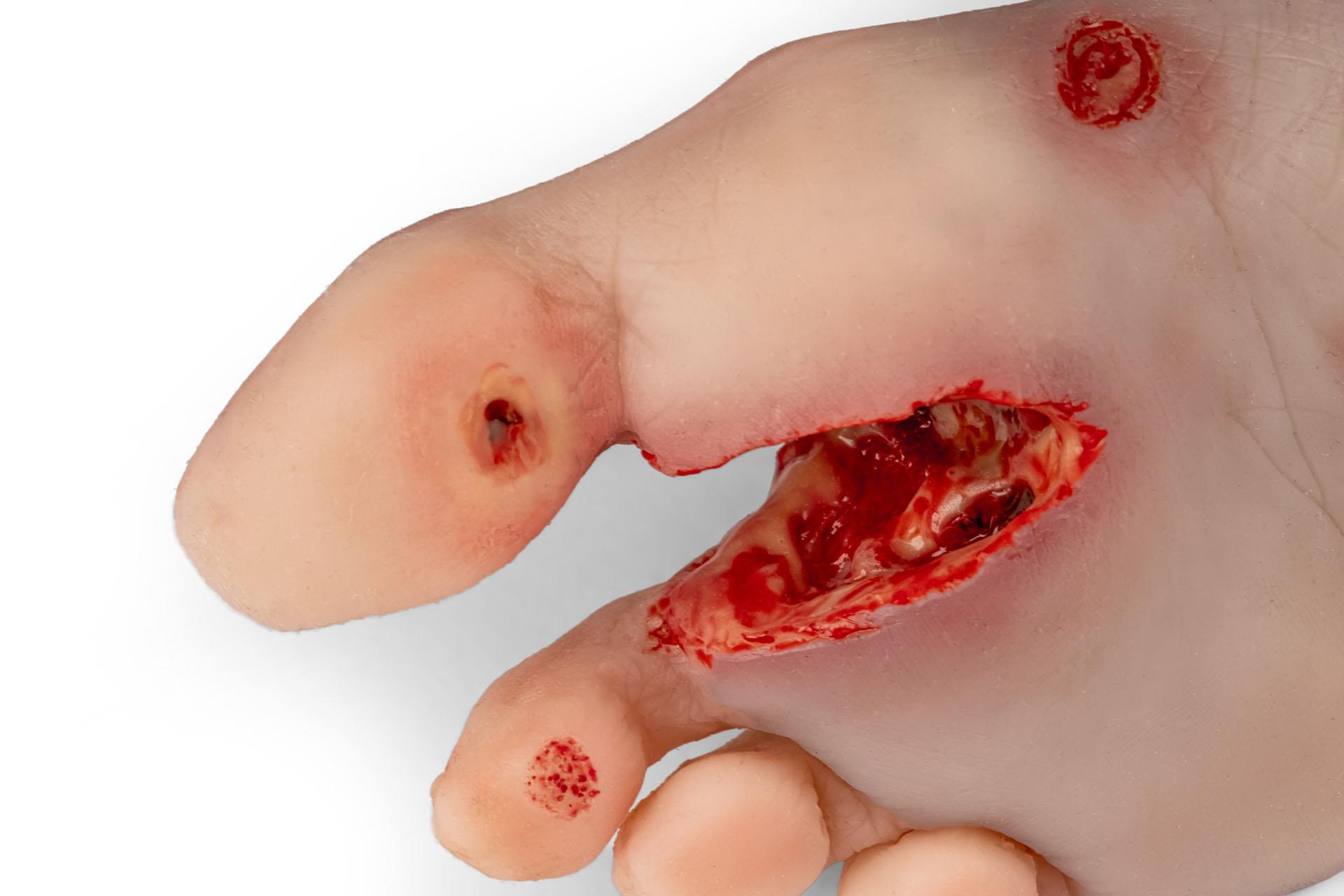 Wundenfuß-mit-diabetischem-Fußsyndrom-fortg-Stadium-für-Nursing-Anne-6