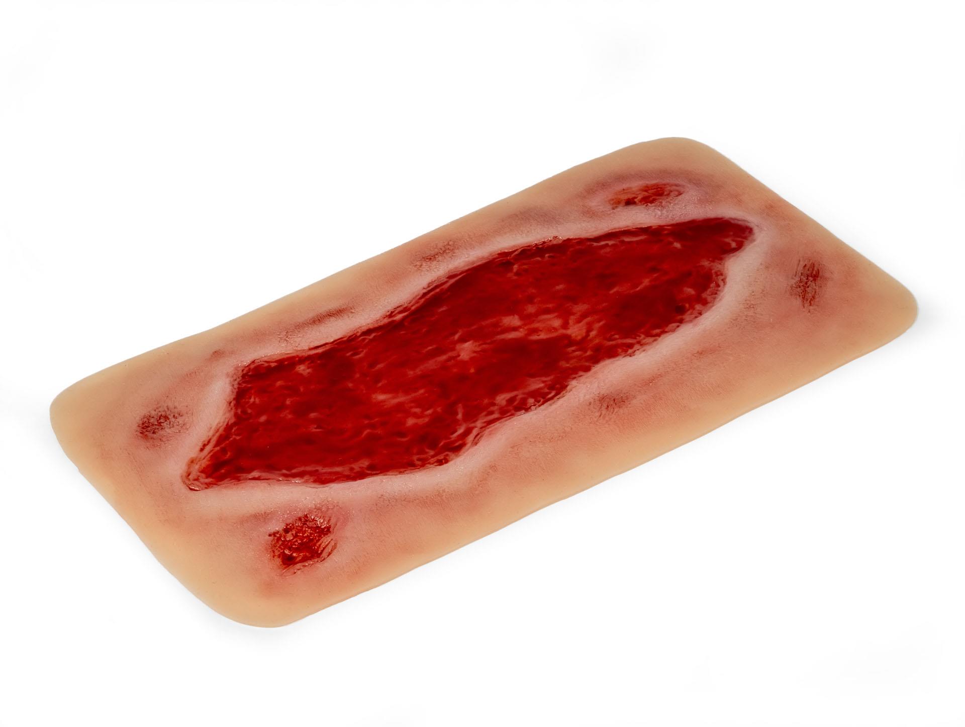 Wound-moulage-arterial-leg-ulcer-large-granulation-phase-2