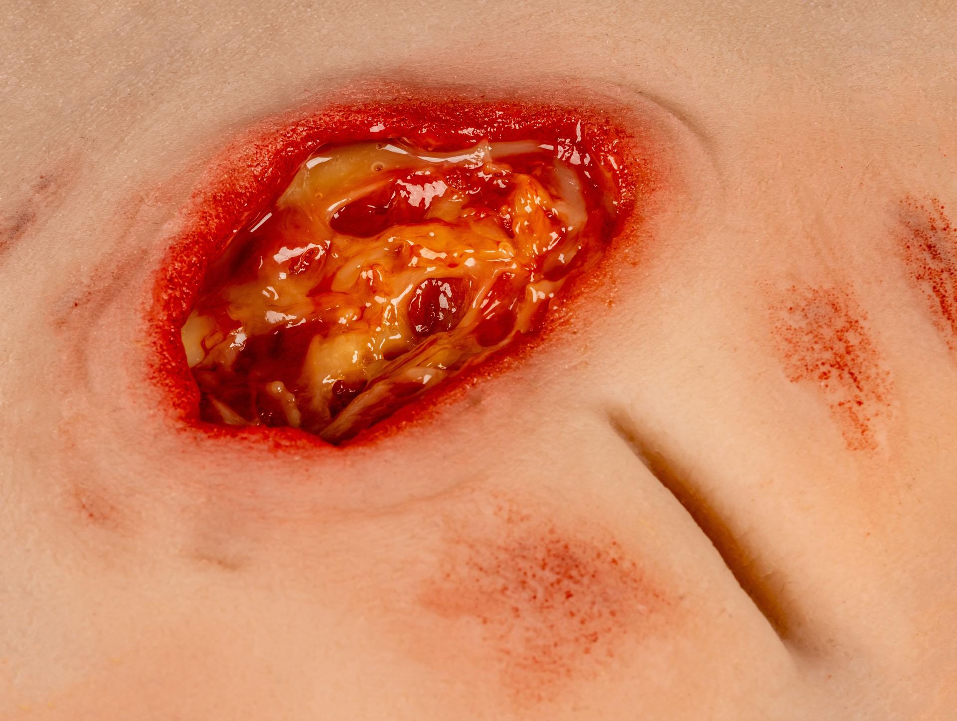 Wound-moulage-sacral-decubitus-cleaned-including-stand-2
