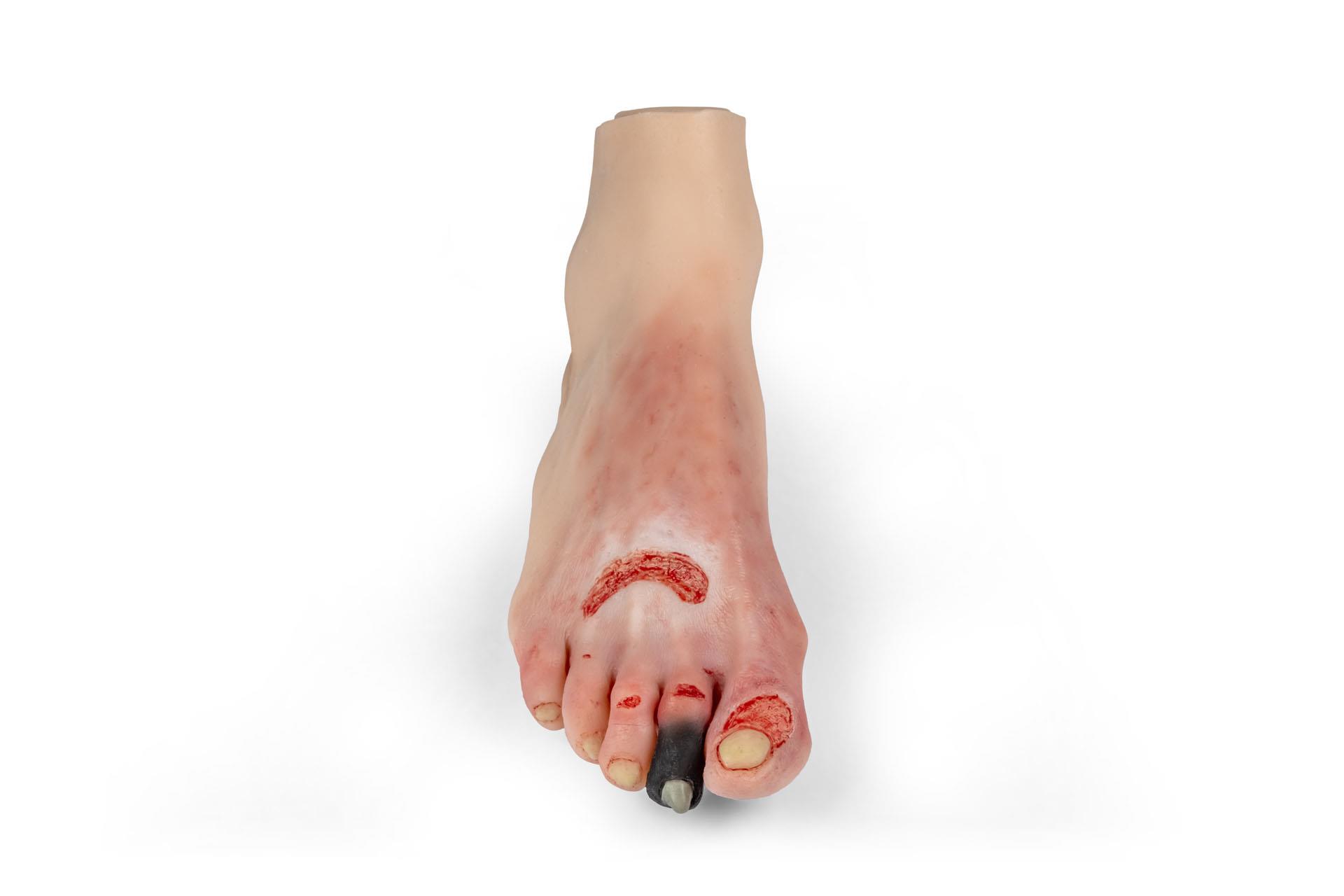 Wound-foot-with-diabetic-foot-syndrome-1