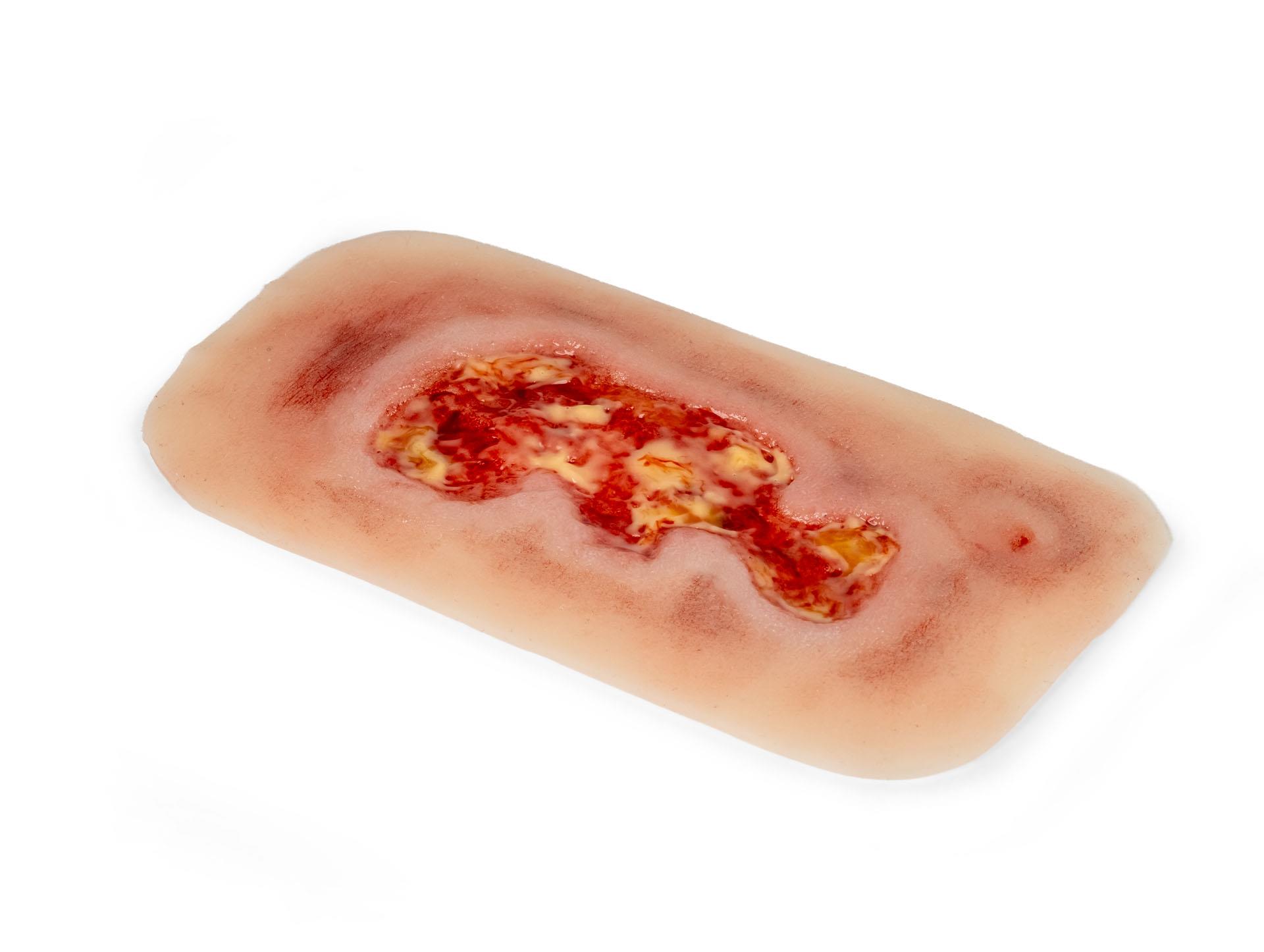 Wound-moulage-venous-leg-ulcer-small-exudation-phase-3