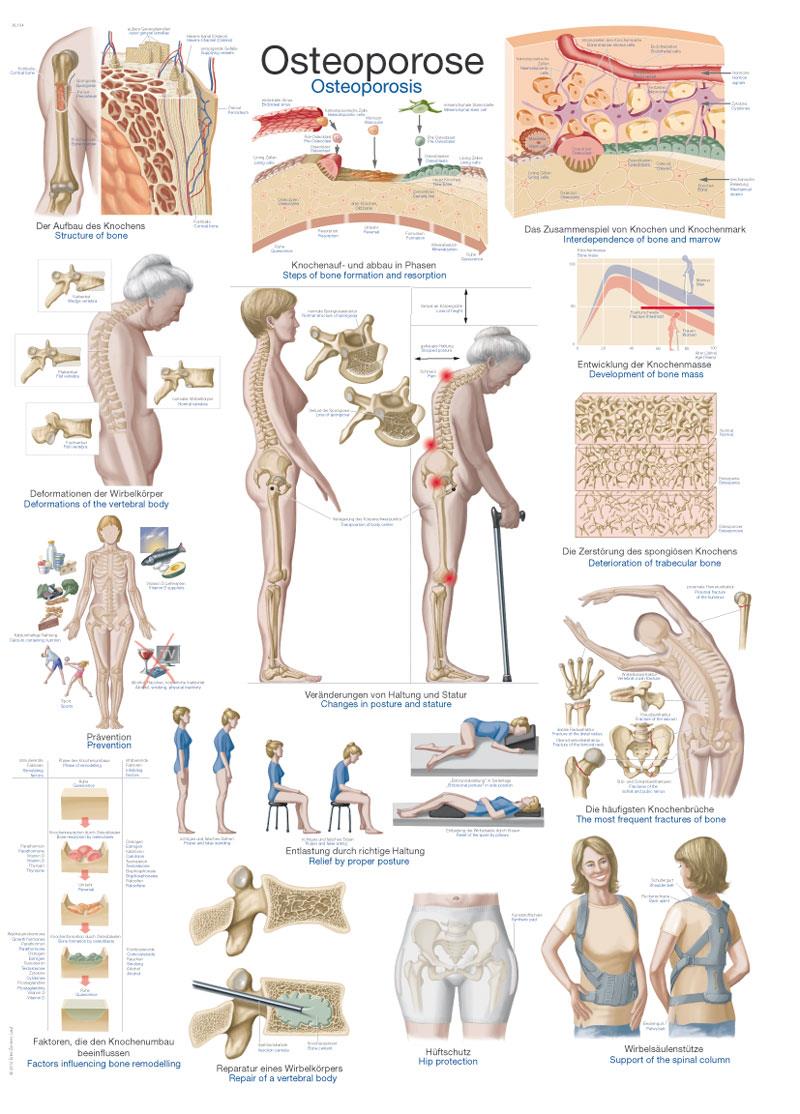 Lehrtafel "Osteoporose", 50x70cm