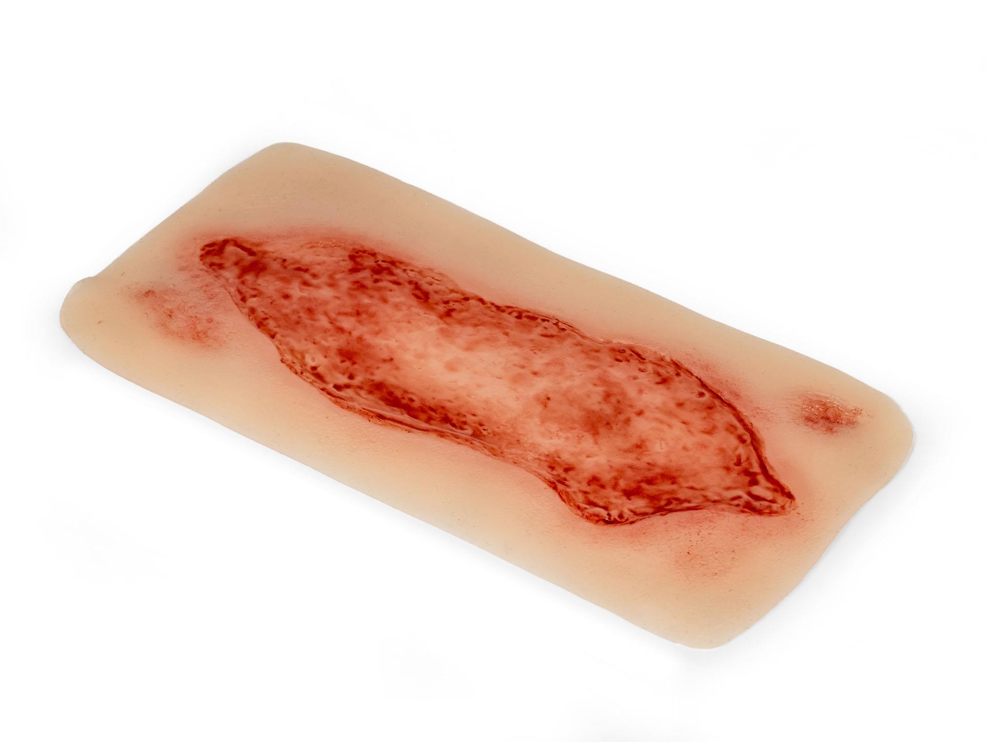 Wundmoulage-Ulcus-Cruris-Arteriosum-groß-Epithelisierungsphase-3