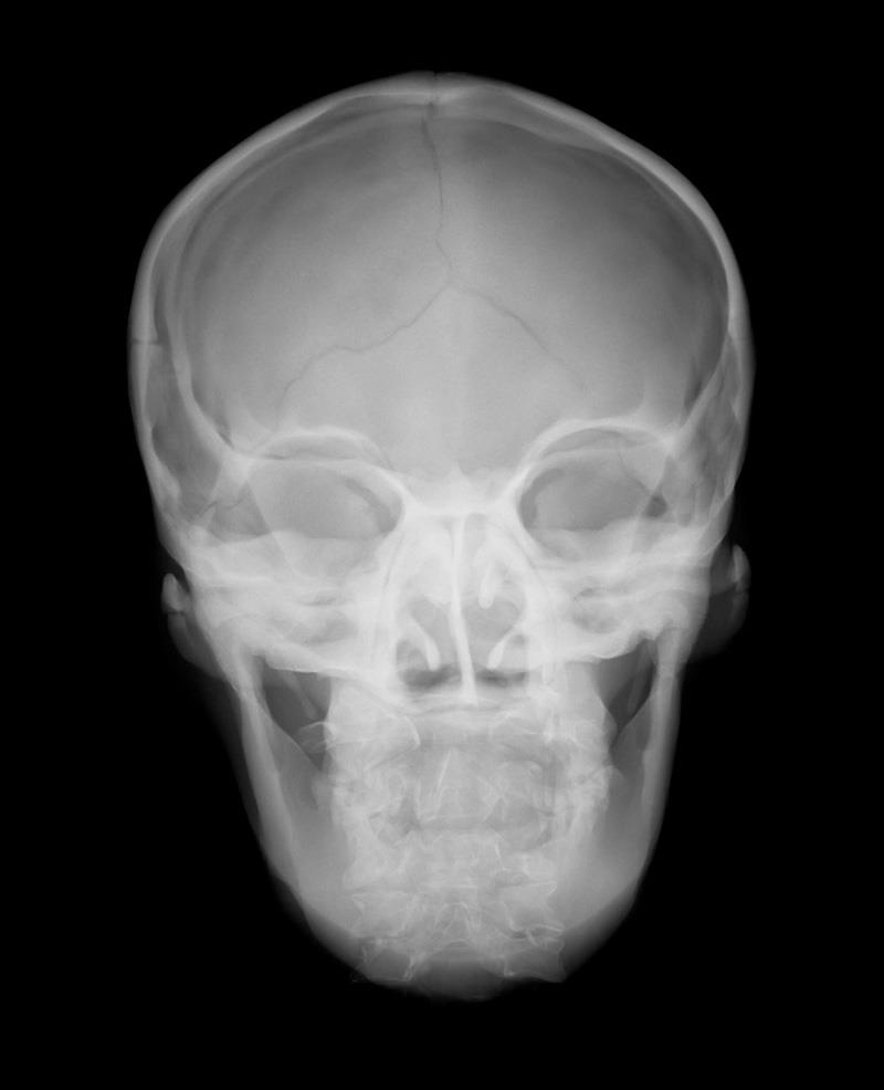 Sectional X-ray phantom with artificial bones - Head phantom, transparent