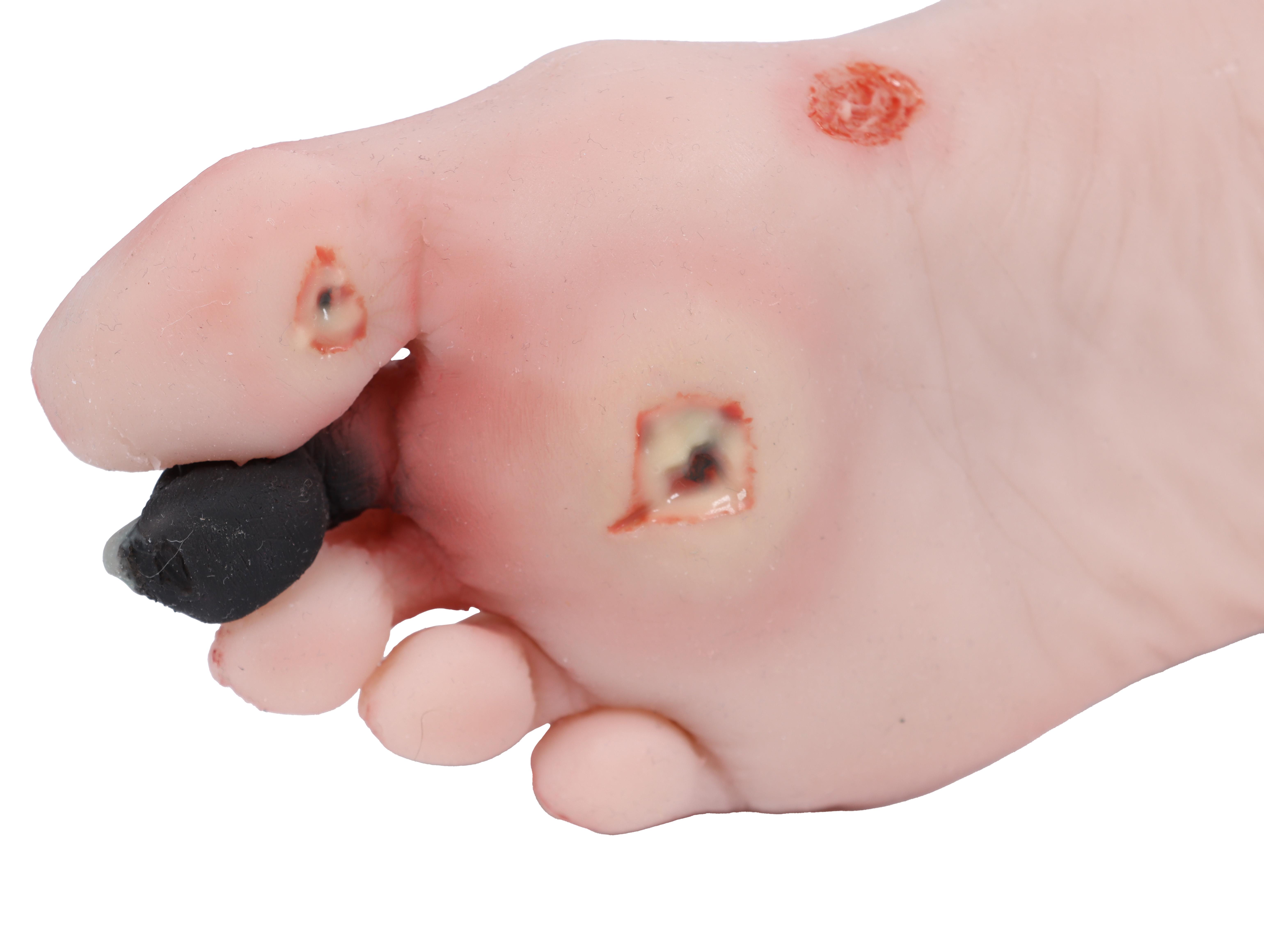 Wound-foot-with-diabetic-foot-syndrome-5