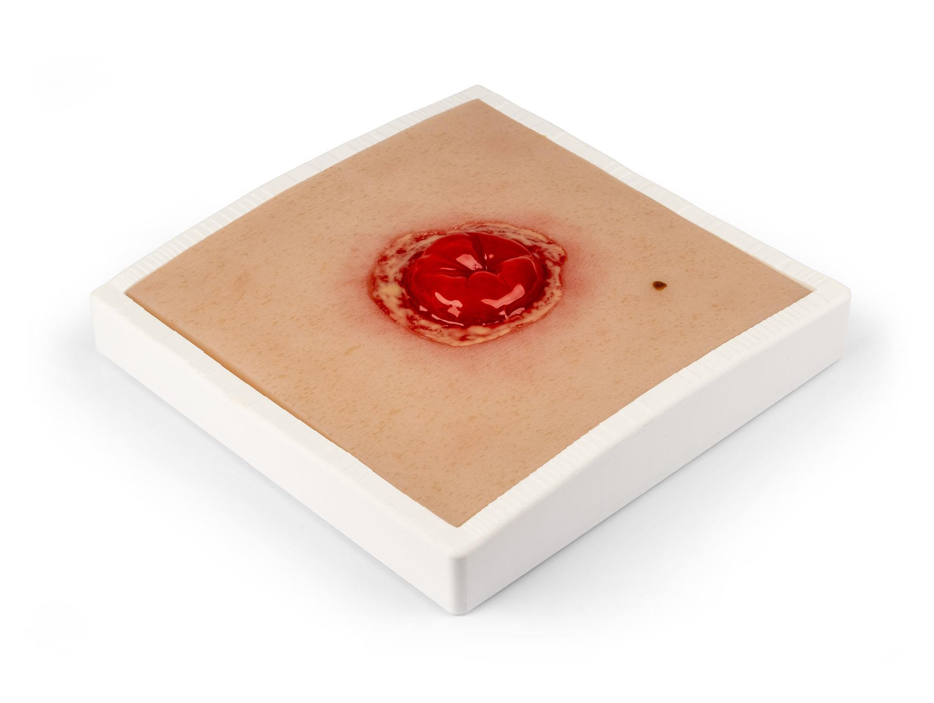 Wound-Moulage-Colostoma-with-inflammation-incl-stand
