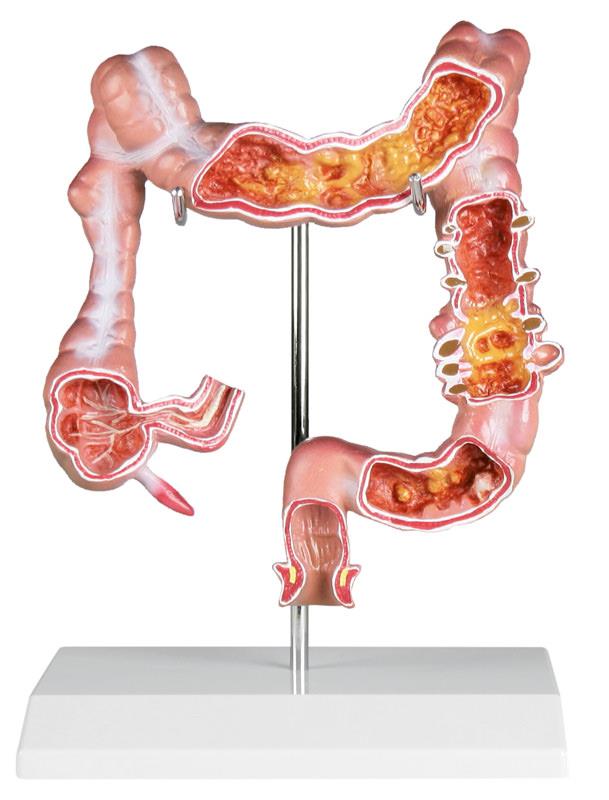 Colon model with diseases