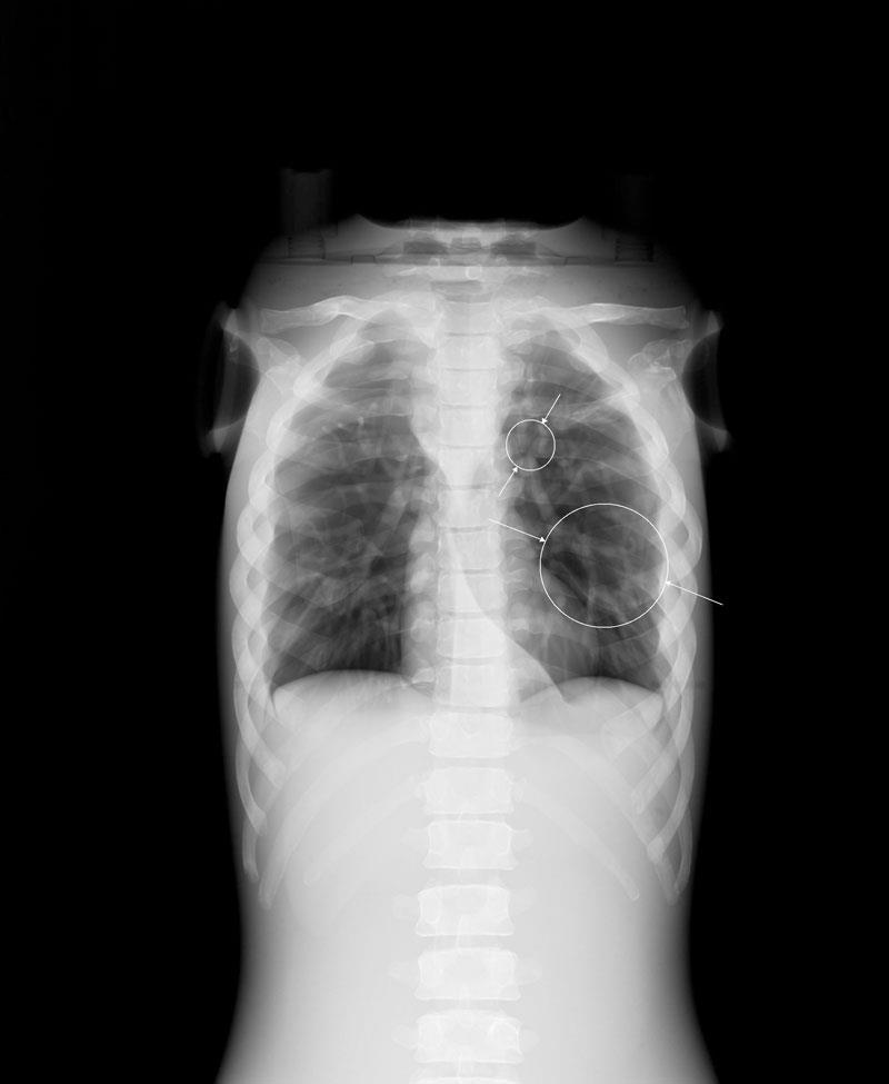 Pädiatrisches Ganzkörper-Röntgenphantom mit Frakturen