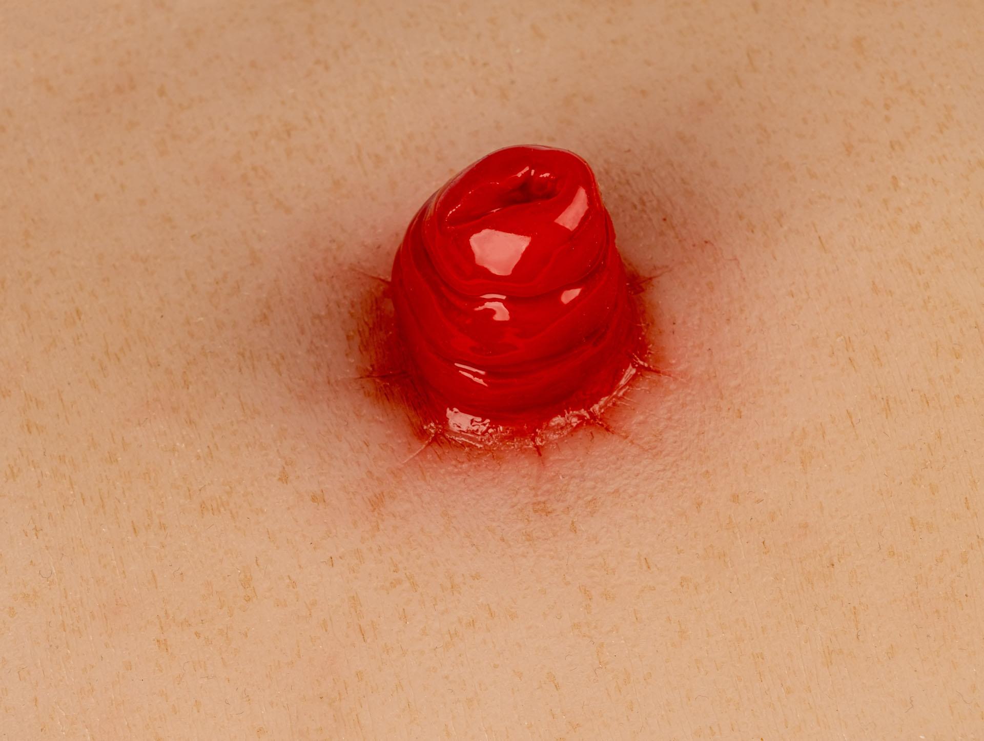 Wound-Moulage-Ileostoma-incl-stand-2