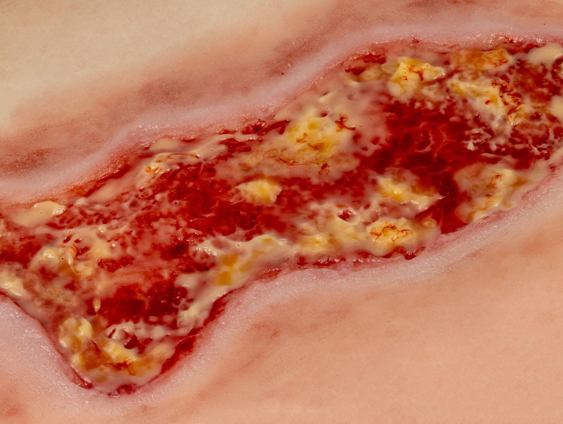 Wound-moulage-venous-leg-ulcer-large-exudation-phase-4