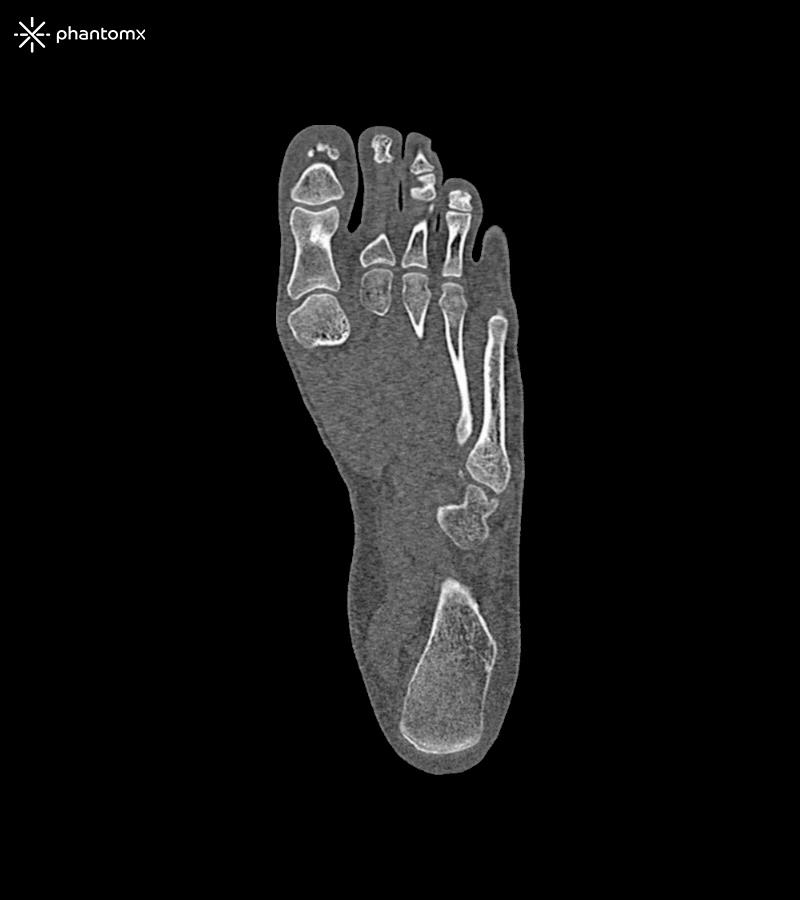Fußphantom-für-CT-Röntgen-und-Strahlentherapie-1