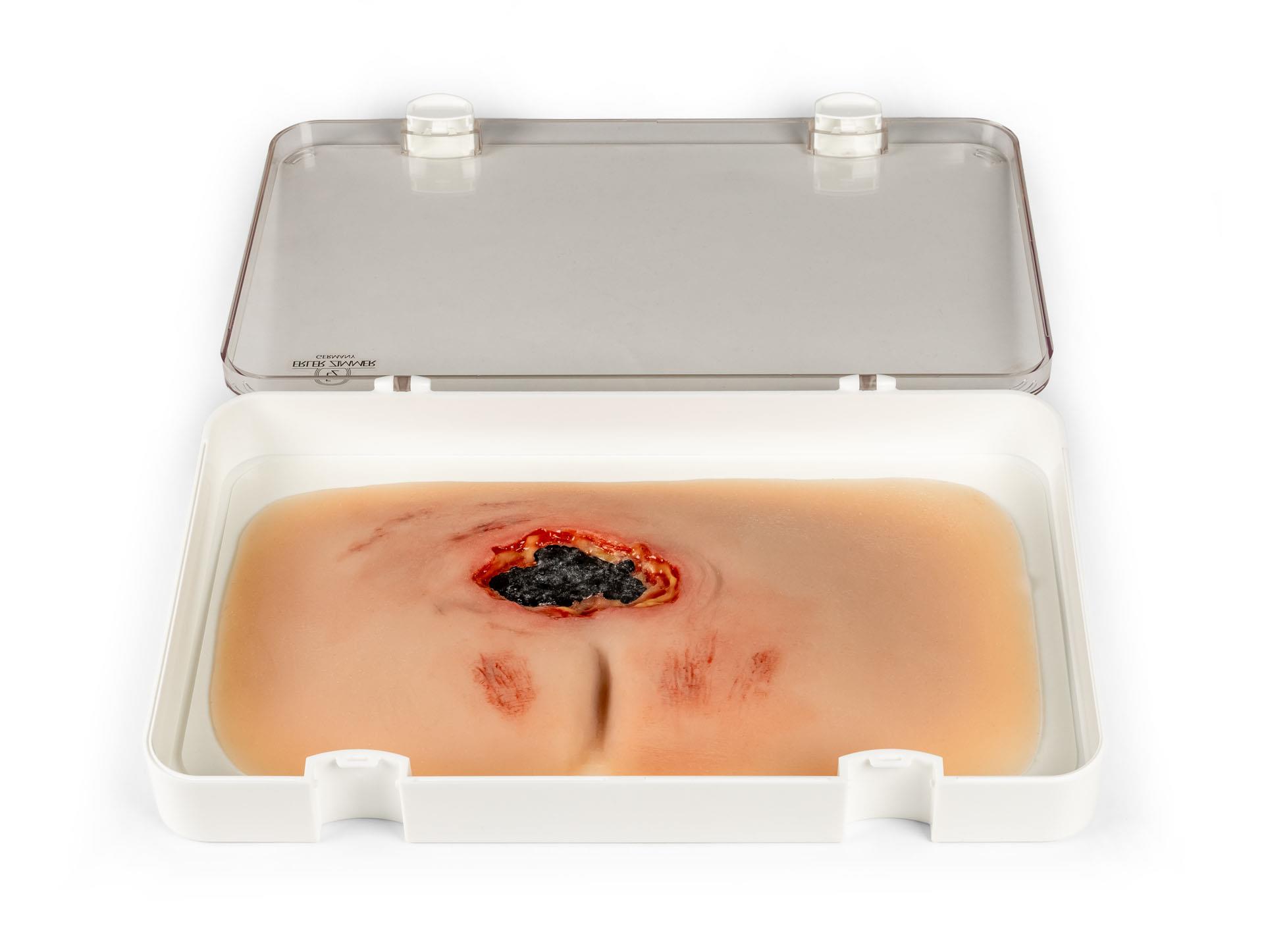 Wundmoulage-sakraler-Dekubitus-unbehandelt
